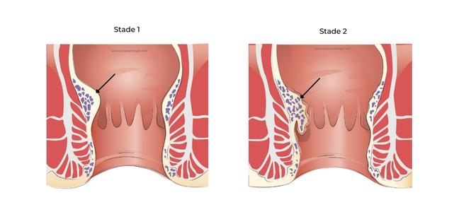 https://coloproctologie.com/wp-content/uploads/2022/06/Stade-1-stade-2-sclérothérapie-.jpg