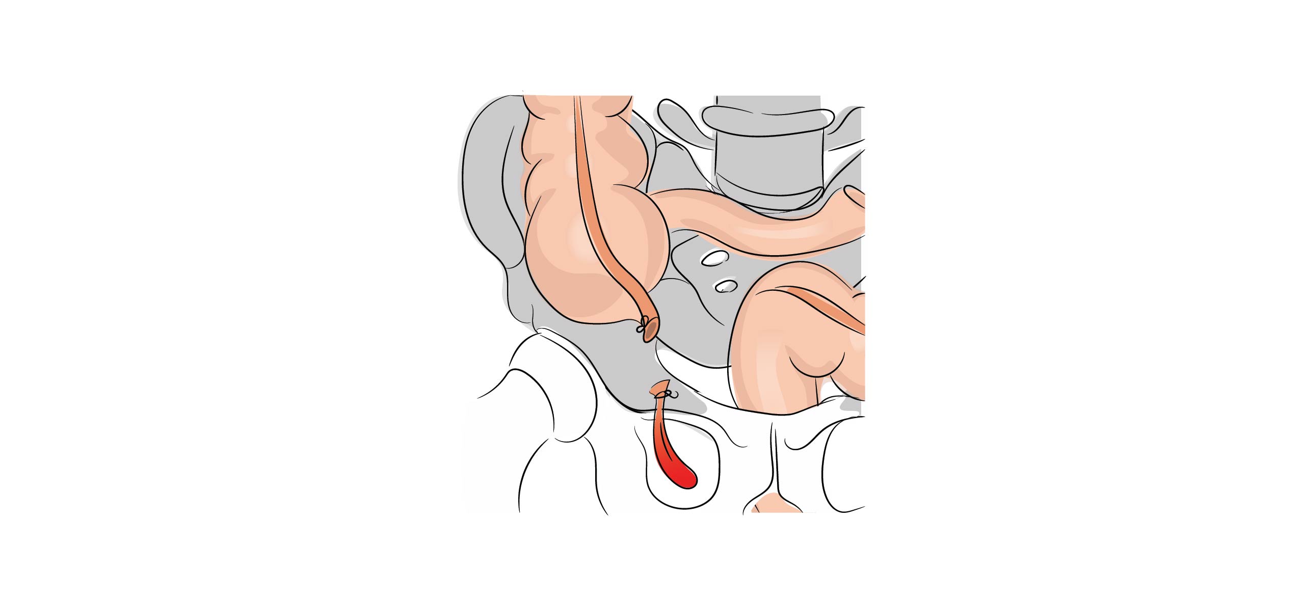 https://coloproctologie.com/wp-content/uploads/2022/07/Appendicectomie-cicatrise-_Résection.jpg