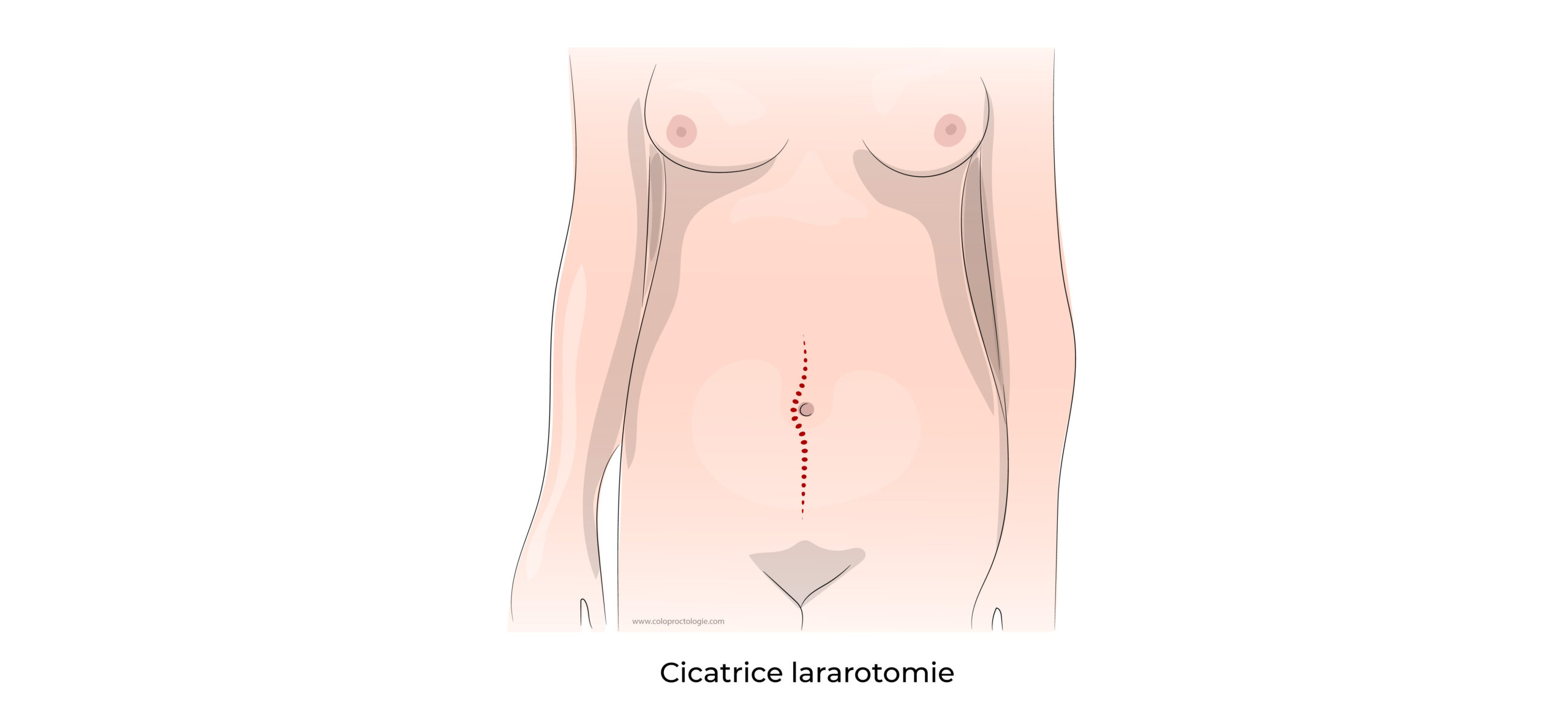 https://coloproctologie.com/wp-content/uploads/2022/07/Colectomie-droite-14-scaled.jpeg