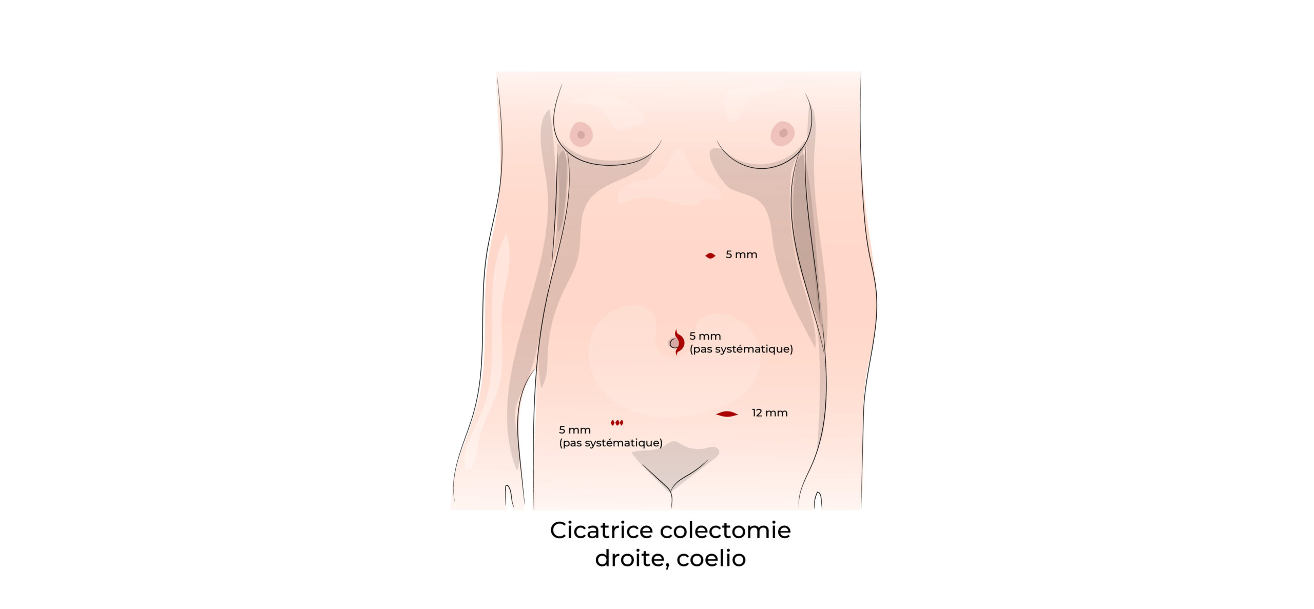 https://coloproctologie.com/wp-content/uploads/2022/07/Colectomie-droite-16-scaled.jpeg
