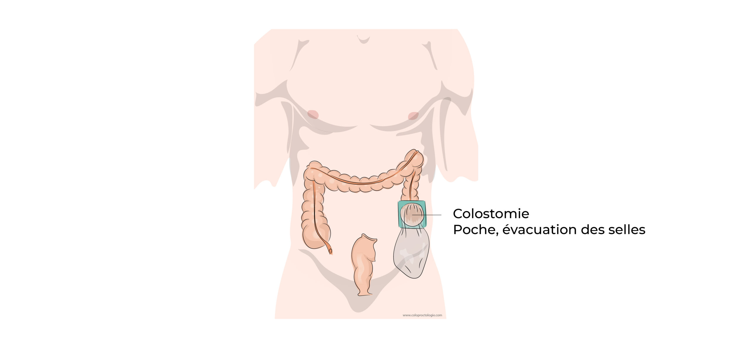 https://coloproctologie.com/wp-content/uploads/2022/07/Colectomie-gauche-12-scaled.jpeg