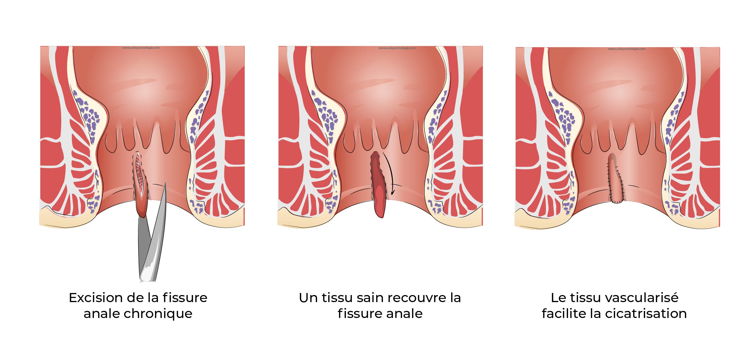 https://coloproctologie.com/wp-content/uploads/2022/07/Fissure-Anale_-13.jpg