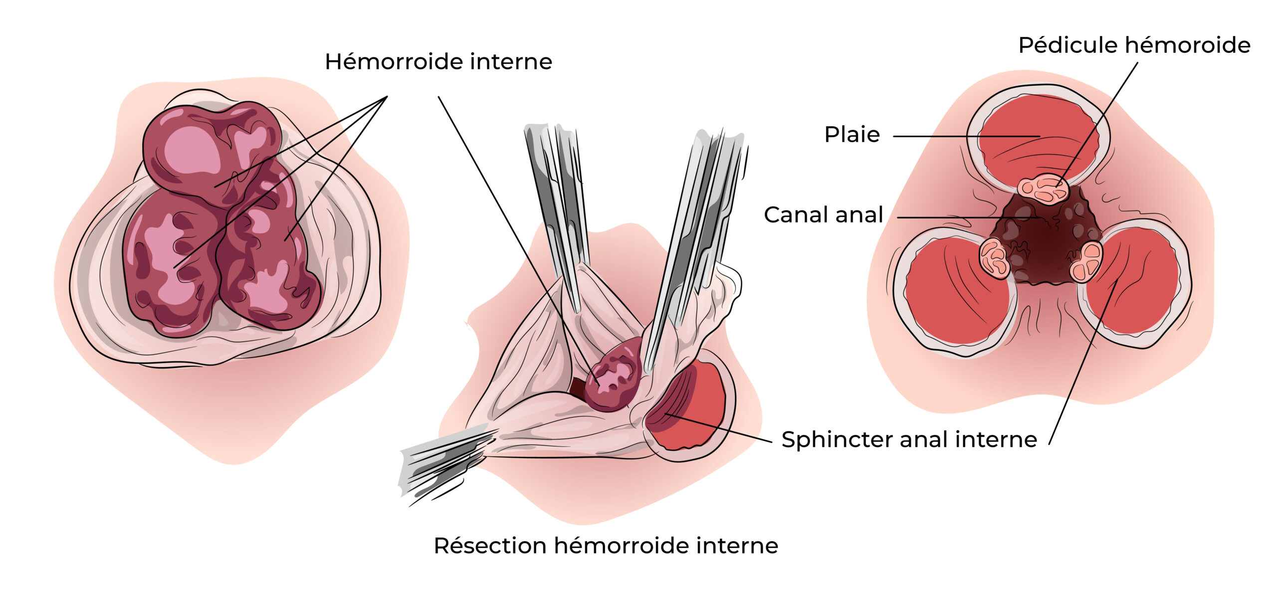 https://coloproctologie.com/wp-content/uploads/2022/07/Hemorroide-27-scaled.jpg