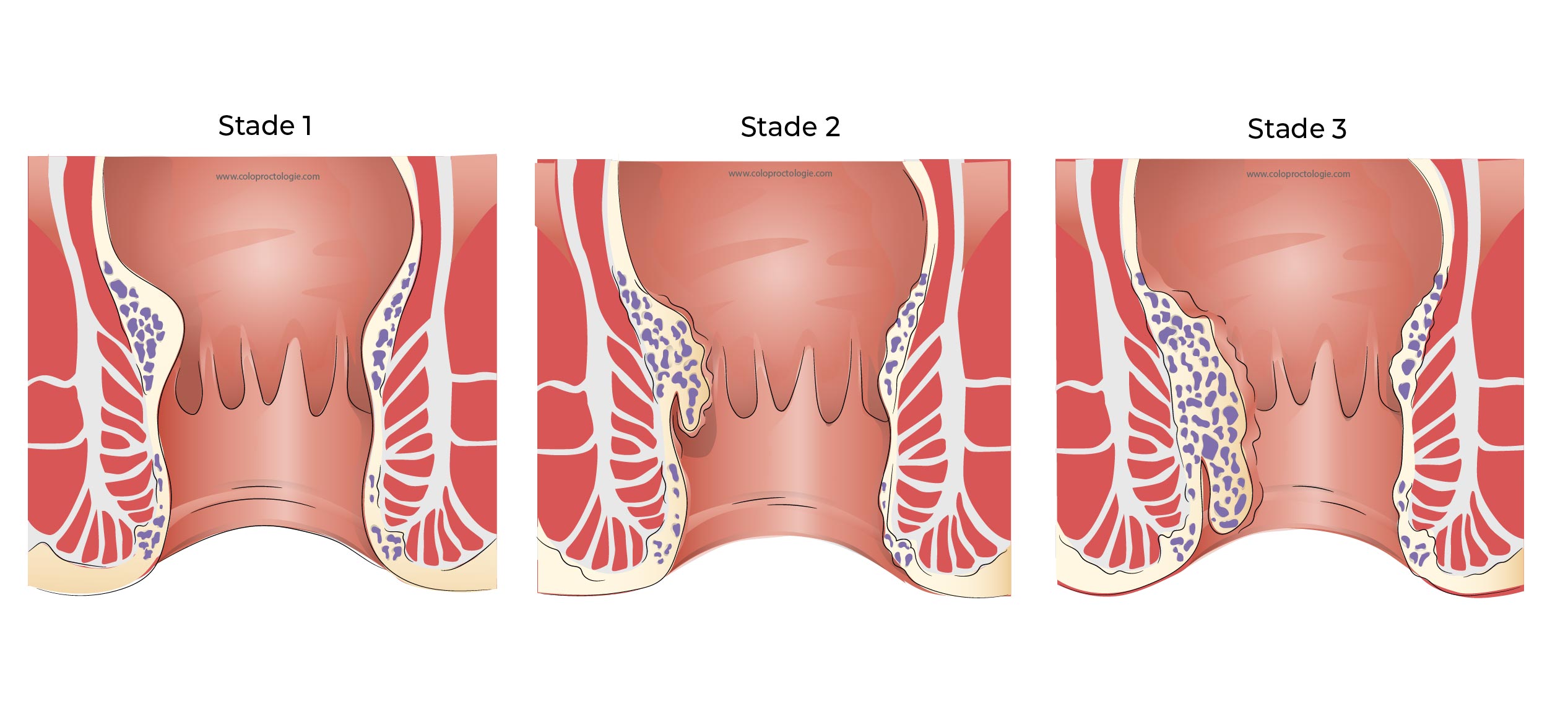 https://coloproctologie.com/wp-content/uploads/2022/07/Hemorroide-34.jpg