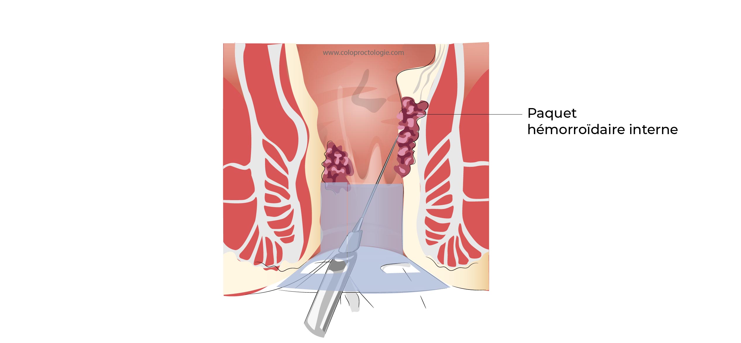 https://coloproctologie.com/wp-content/uploads/2022/07/Hemorroide-35-1.jpg