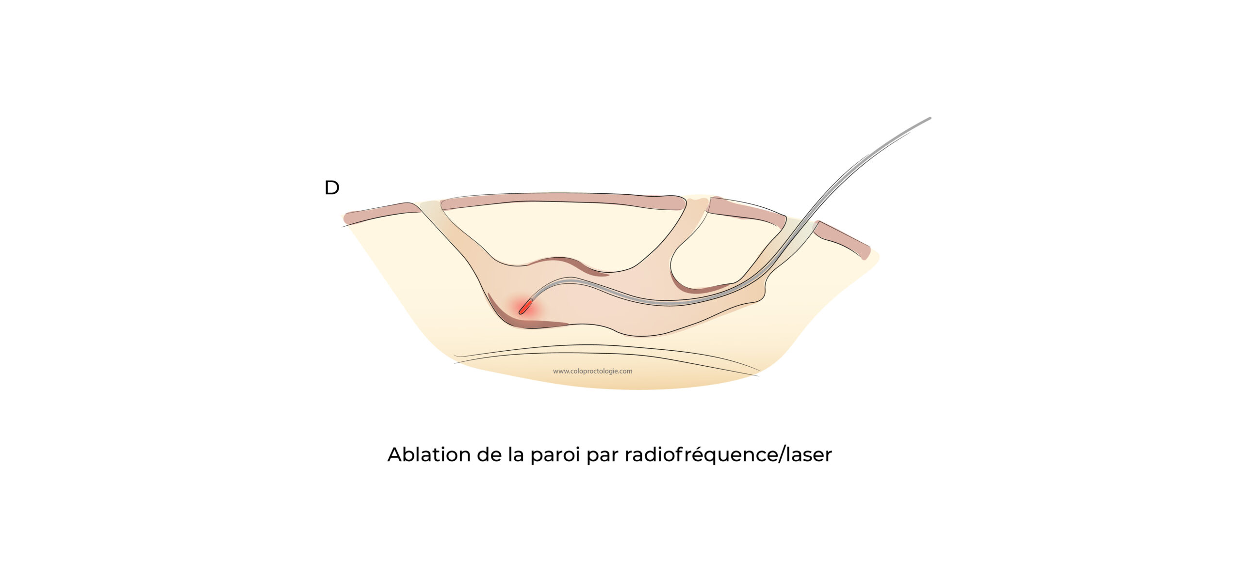 https://coloproctologie.com/wp-content/uploads/2022/07/Kyste-Pilonidale-Illustrations-19-scaled.jpeg