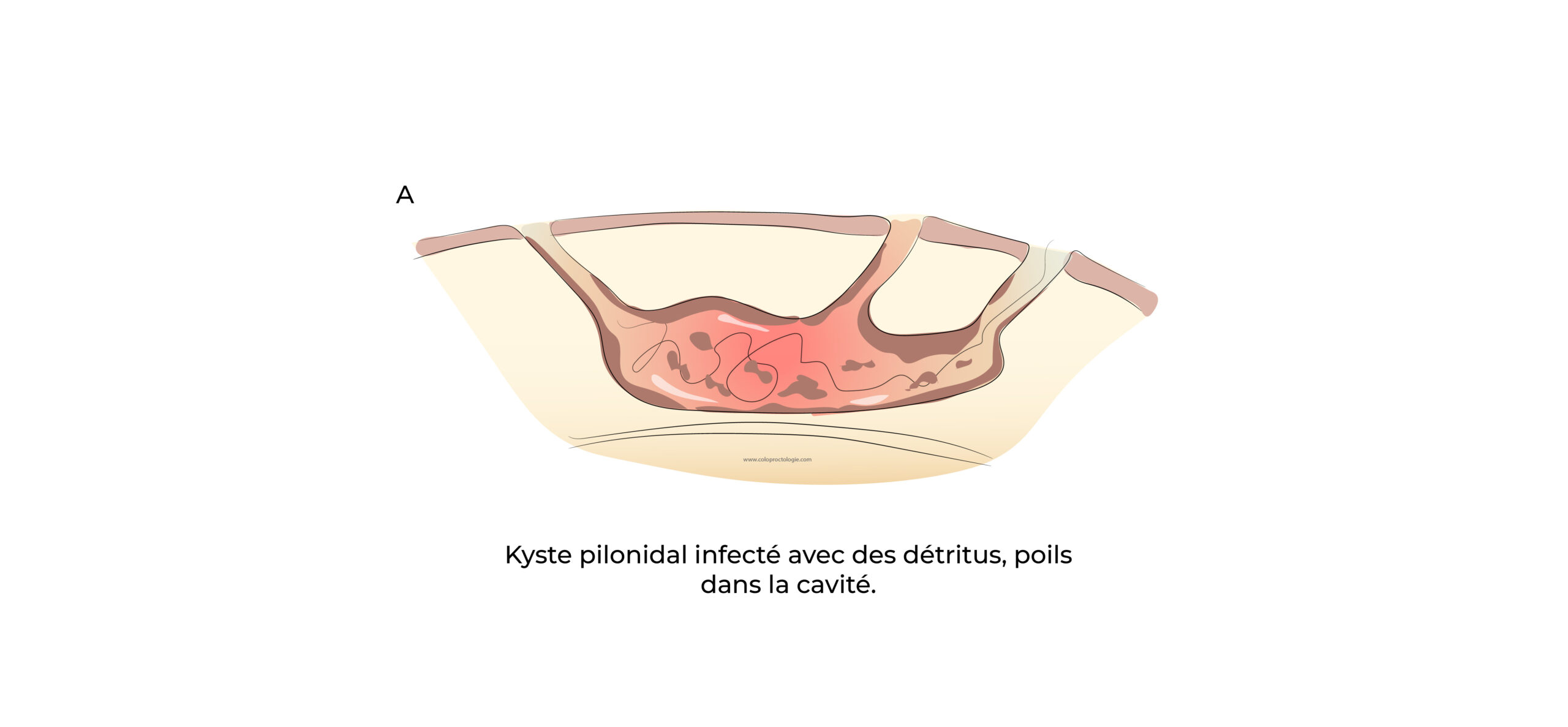 https://coloproctologie.com/wp-content/uploads/2022/07/Kyste-Pilonidale-Illustrations-24-scaled.jpeg