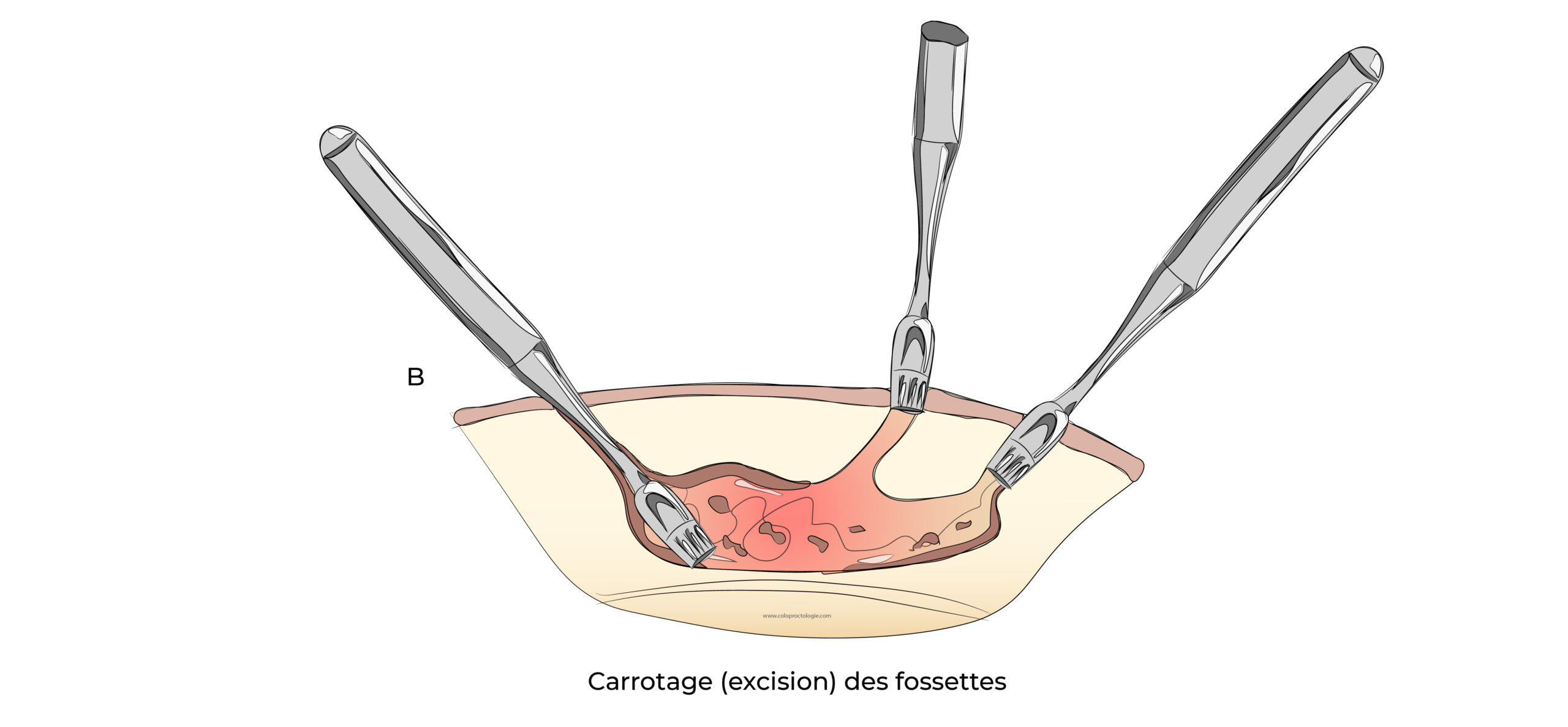 https://coloproctologie.com/wp-content/uploads/2022/07/Kyste-Pilonidale-Illustrations-25-scaled.jpeg