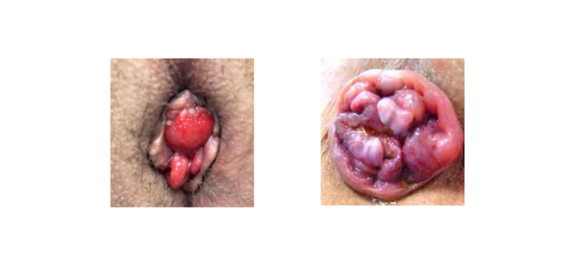 https://coloproctologie.com/wp-content/uploads/2022/07/hémorroidectomie-2.png