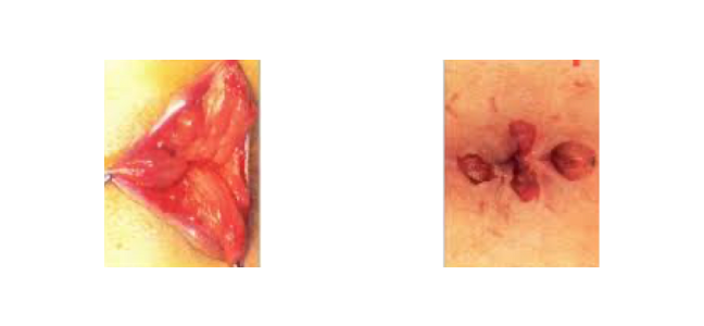 https://coloproctologie.com/wp-content/uploads/2022/07/hémorroidectomie-3.png