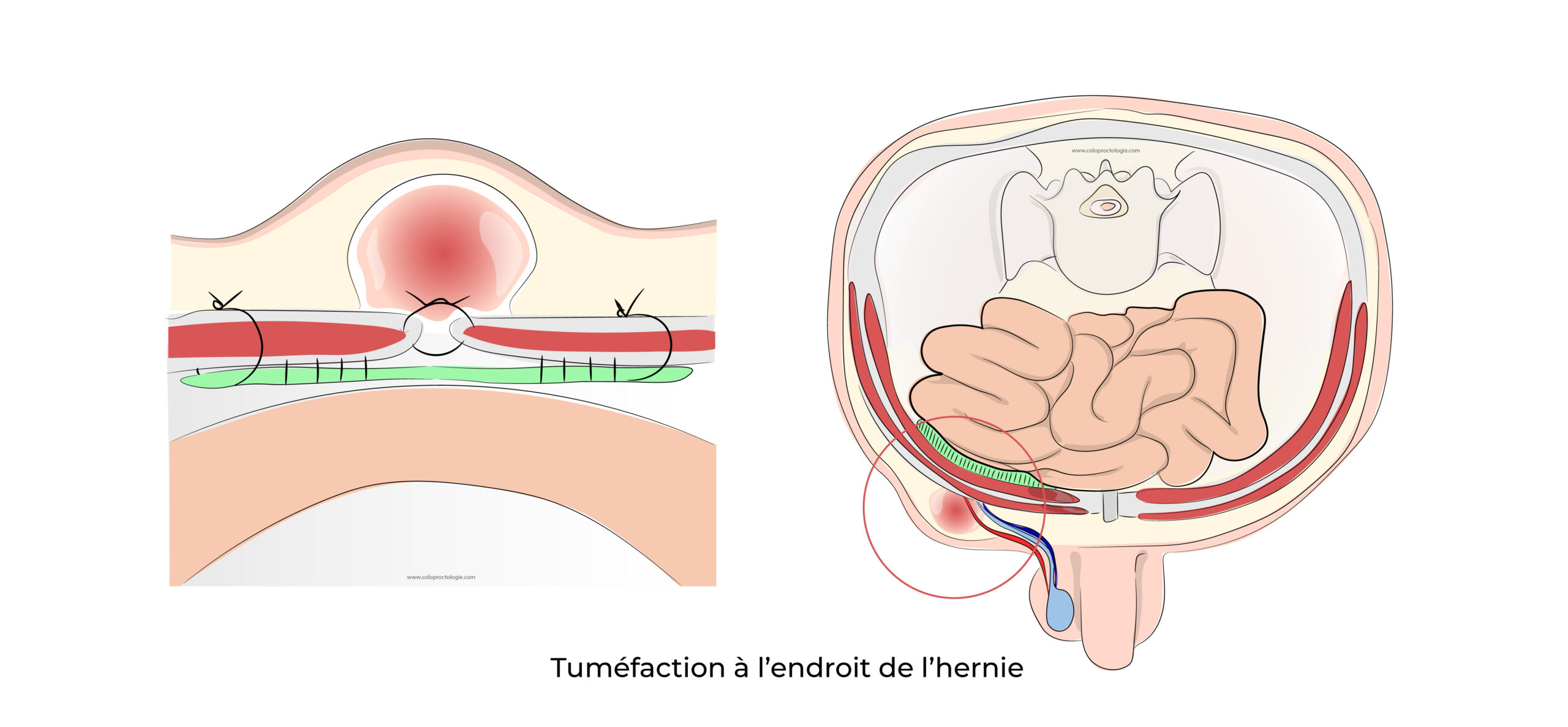 https://coloproctologie.com/wp-content/uploads/2022/08/Hernie-Inguinales-Illustrations-scaled.jpeg