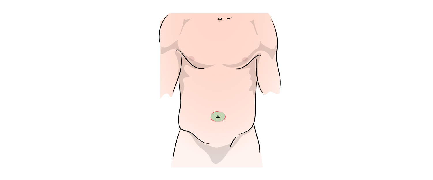 https://coloproctologie.com/wp-content/uploads/2022/08/Hernie-Ombilicale-Illustrations-_Vignette-copy-2.jpeg