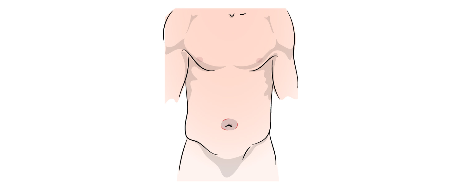 https://coloproctologie.com/wp-content/uploads/2022/08/Hernie-Ombilicale-Illustrations-_Vignette-copy-4.jpeg