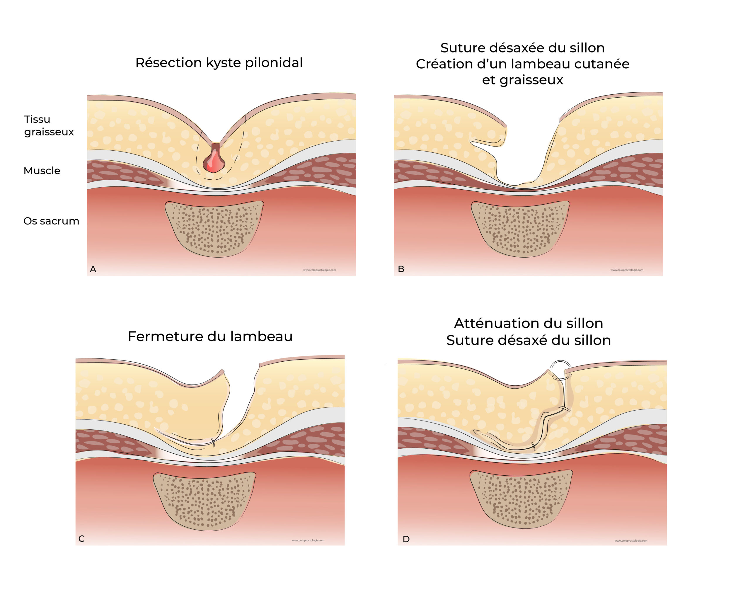 https://coloproctologie.com/wp-content/uploads/2022/08/Kyste-Pilonidale-Illustrations-scaled.jpeg