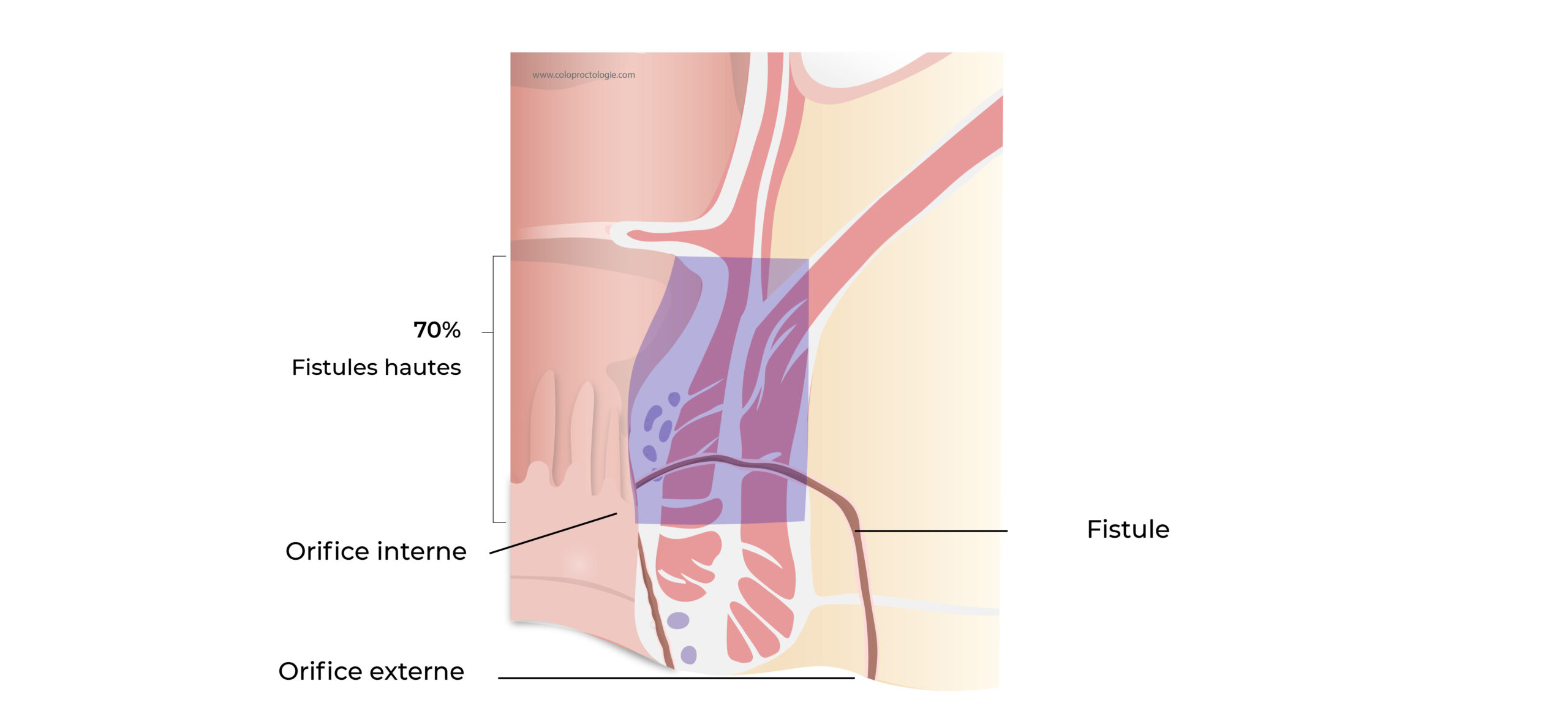 https://coloproctologie.com/wp-content/uploads/2022/10/Fistule-Anale-19-scaled.jpeg