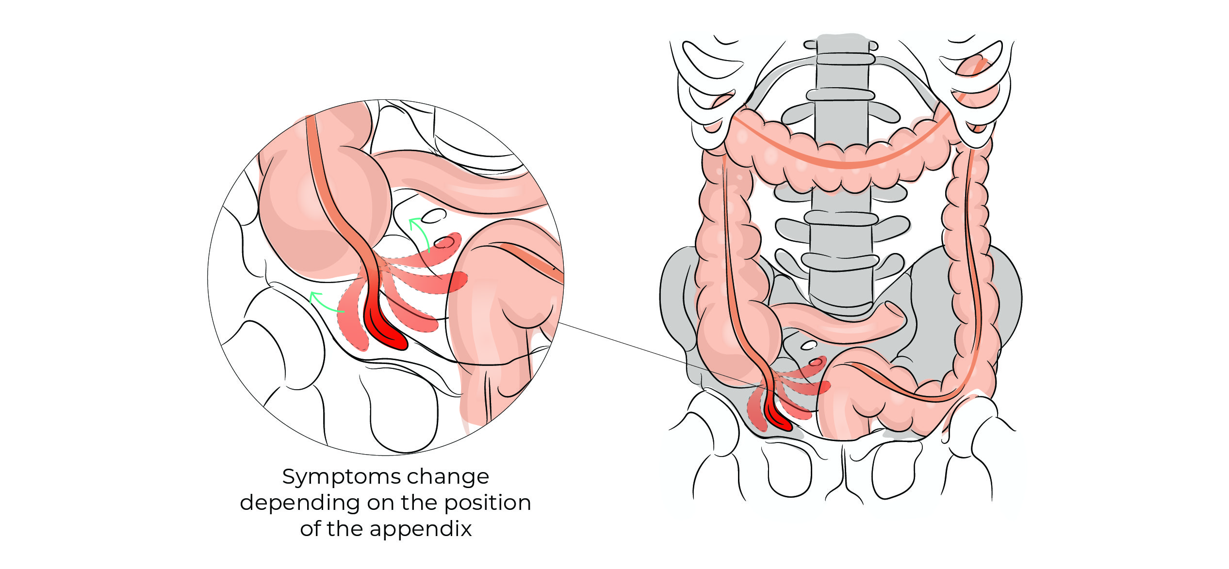 https://coloproctologie.com/wp-content/uploads/2023/01/Appendix-11.jpg