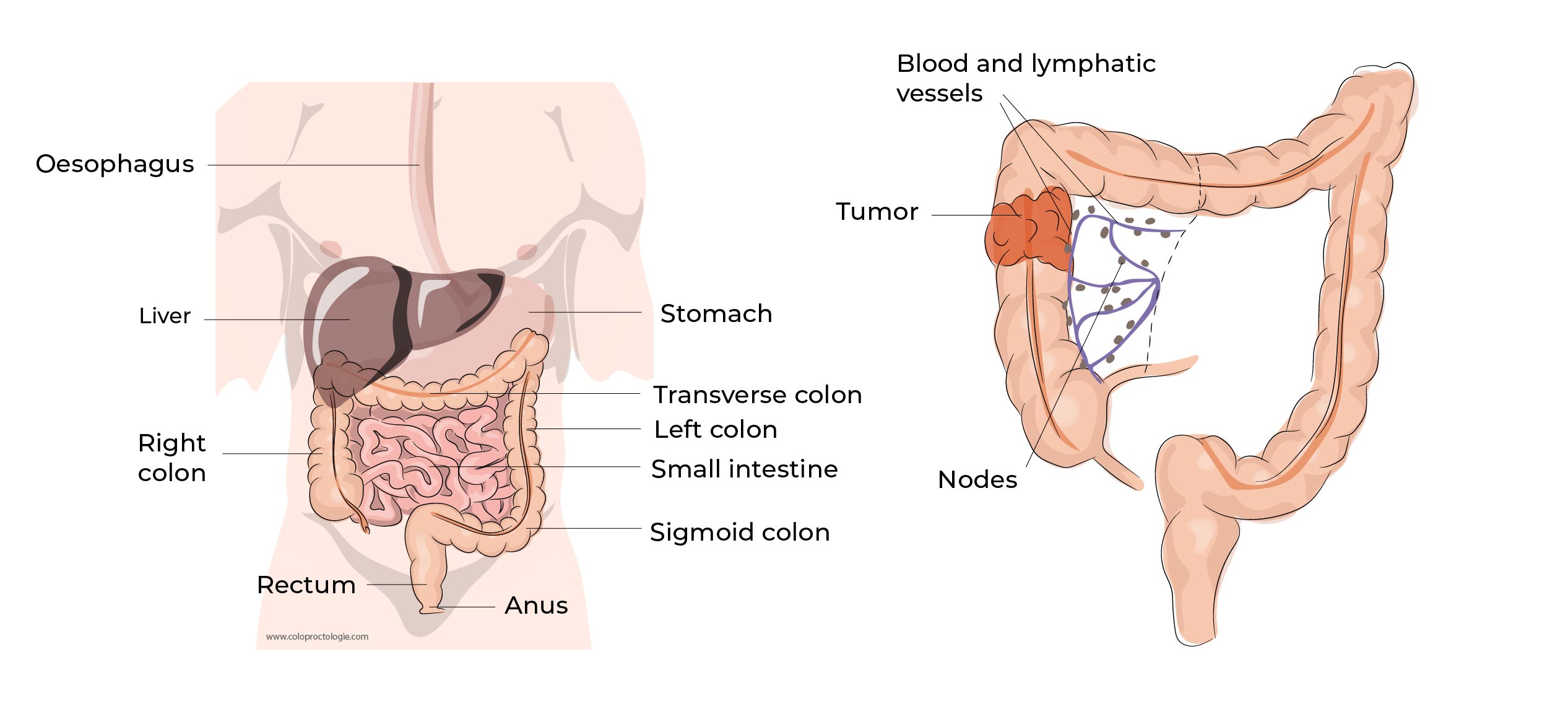 https://coloproctologie.com/wp-content/uploads/2023/01/Cancer-colorectal-10.jpg