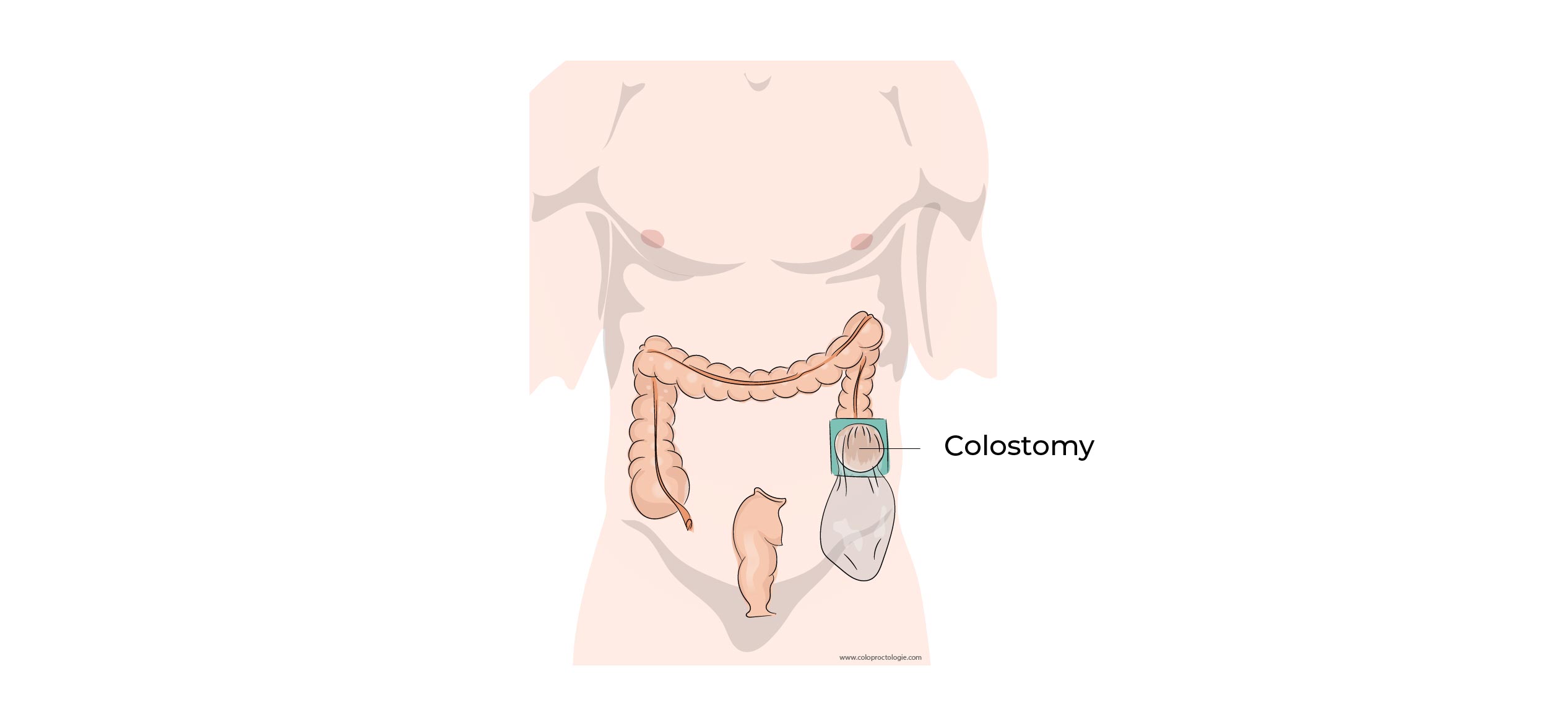 https://coloproctologie.com/wp-content/uploads/2023/01/Colectomie-droite-17.jpg