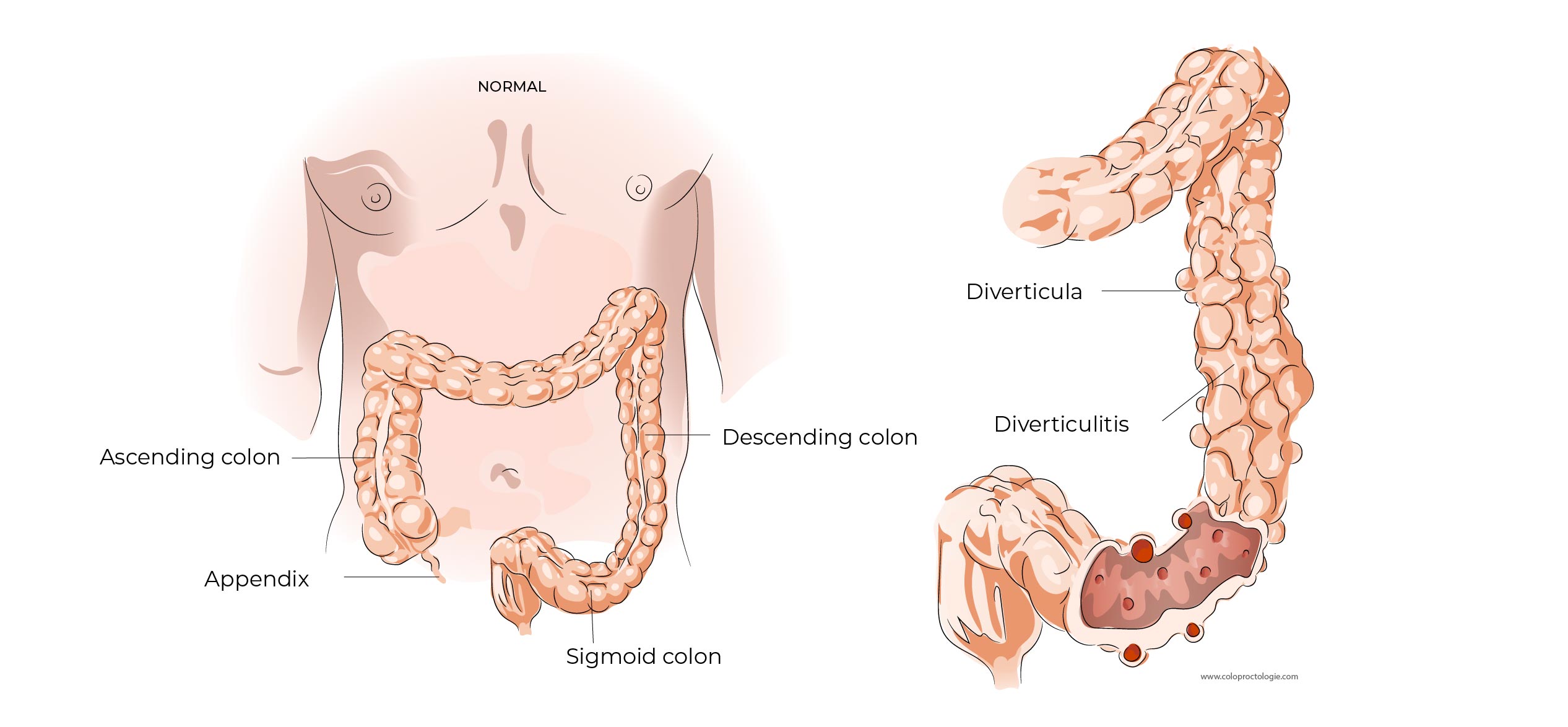 https://coloproctologie.com/wp-content/uploads/2023/01/Diverticulite-aigue-34.jpg