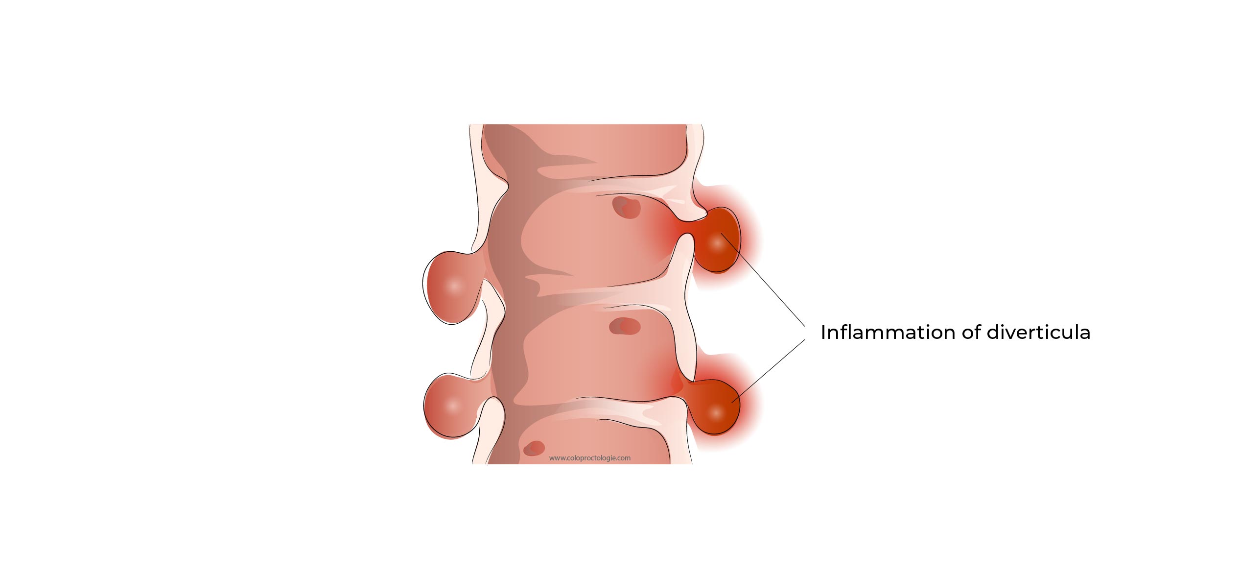 https://coloproctologie.com/wp-content/uploads/2023/01/Diverticulite-aigue-37.jpg