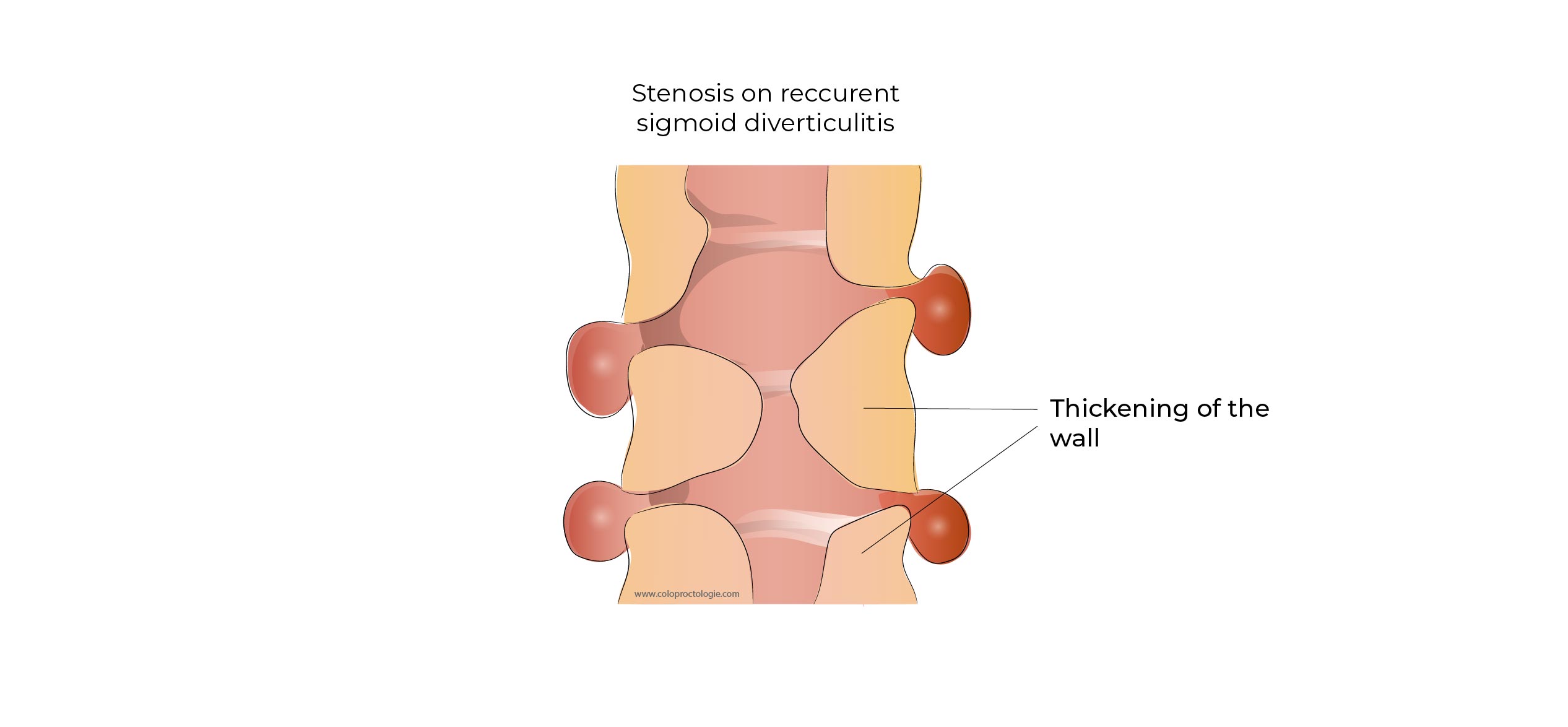 https://coloproctologie.com/wp-content/uploads/2023/01/Diverticulite-aigue-39.jpg