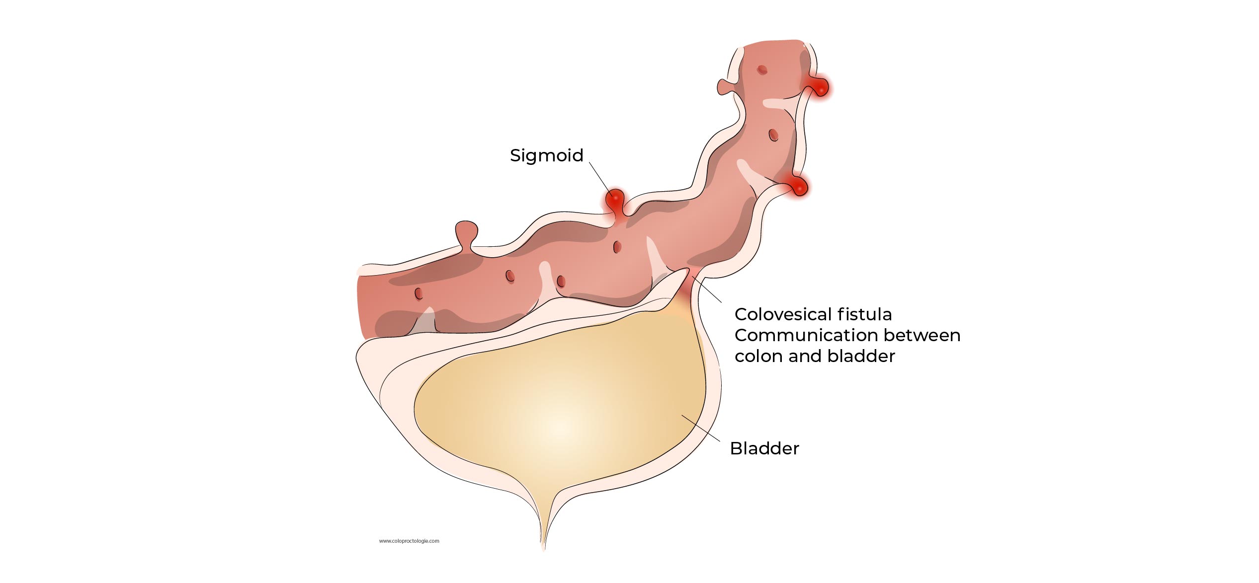 https://coloproctologie.com/wp-content/uploads/2023/01/Diverticulite-aigue-40.jpg