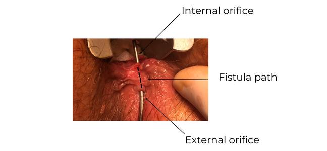 https://coloproctologie.com/wp-content/uploads/2023/01/Fistule-anale-English.jpg