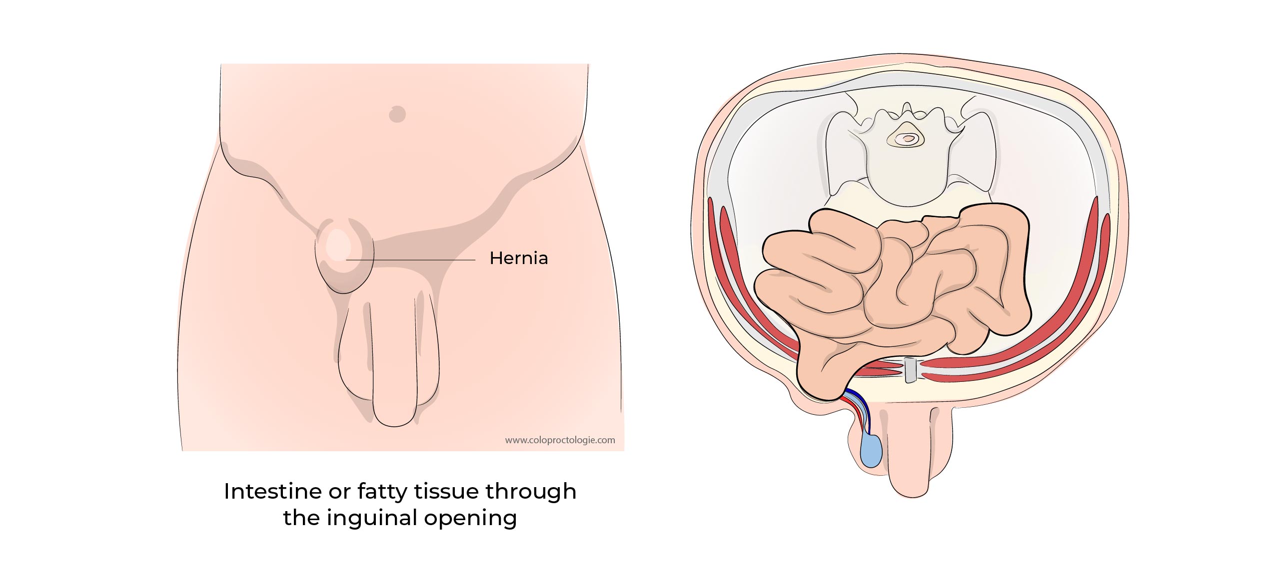 https://coloproctologie.com/wp-content/uploads/2023/01/Hernie-Inguinales-Illustrations-29-1.jpg