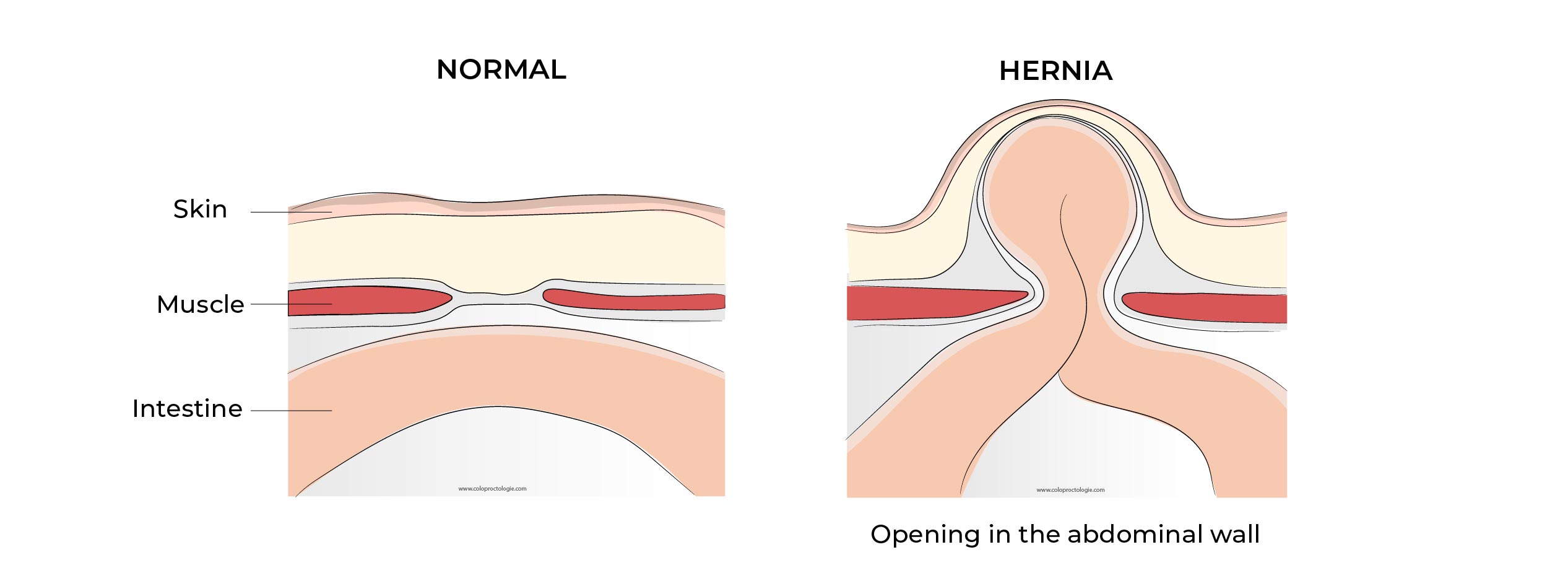 https://coloproctologie.com/wp-content/uploads/2023/01/Hernie-Ombilicale-Illustrations-32-1.jpg