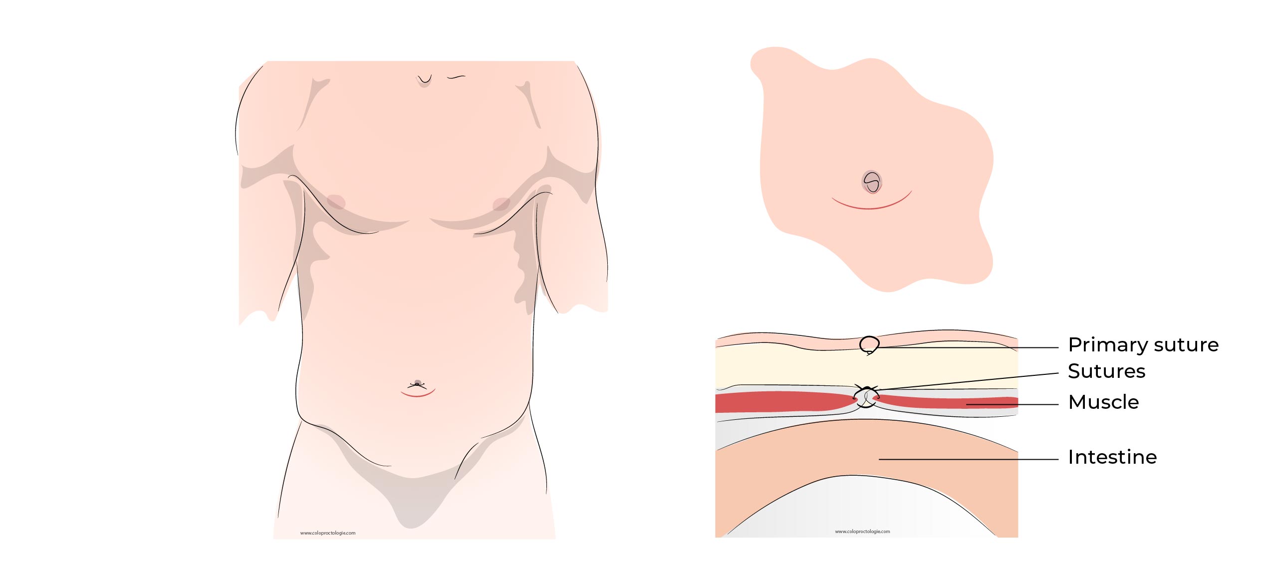 https://coloproctologie.com/wp-content/uploads/2023/01/Hernie-Ombilicale-Illustrations-34.jpg