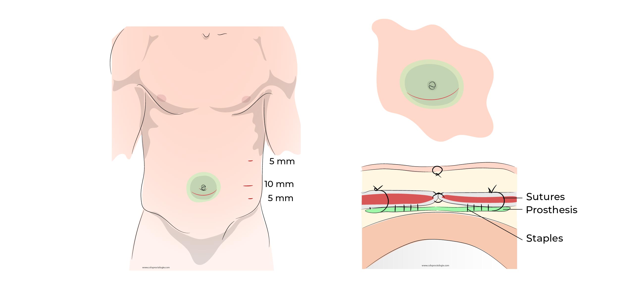 https://coloproctologie.com/wp-content/uploads/2023/01/Hernie-Ombilicale-Illustrations-35.jpg