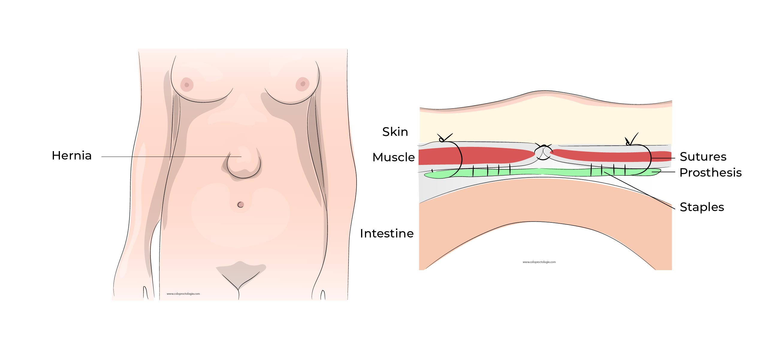 https://coloproctologie.com/wp-content/uploads/2023/01/Hernie-Ombilicale-Illustrations-36.jpg