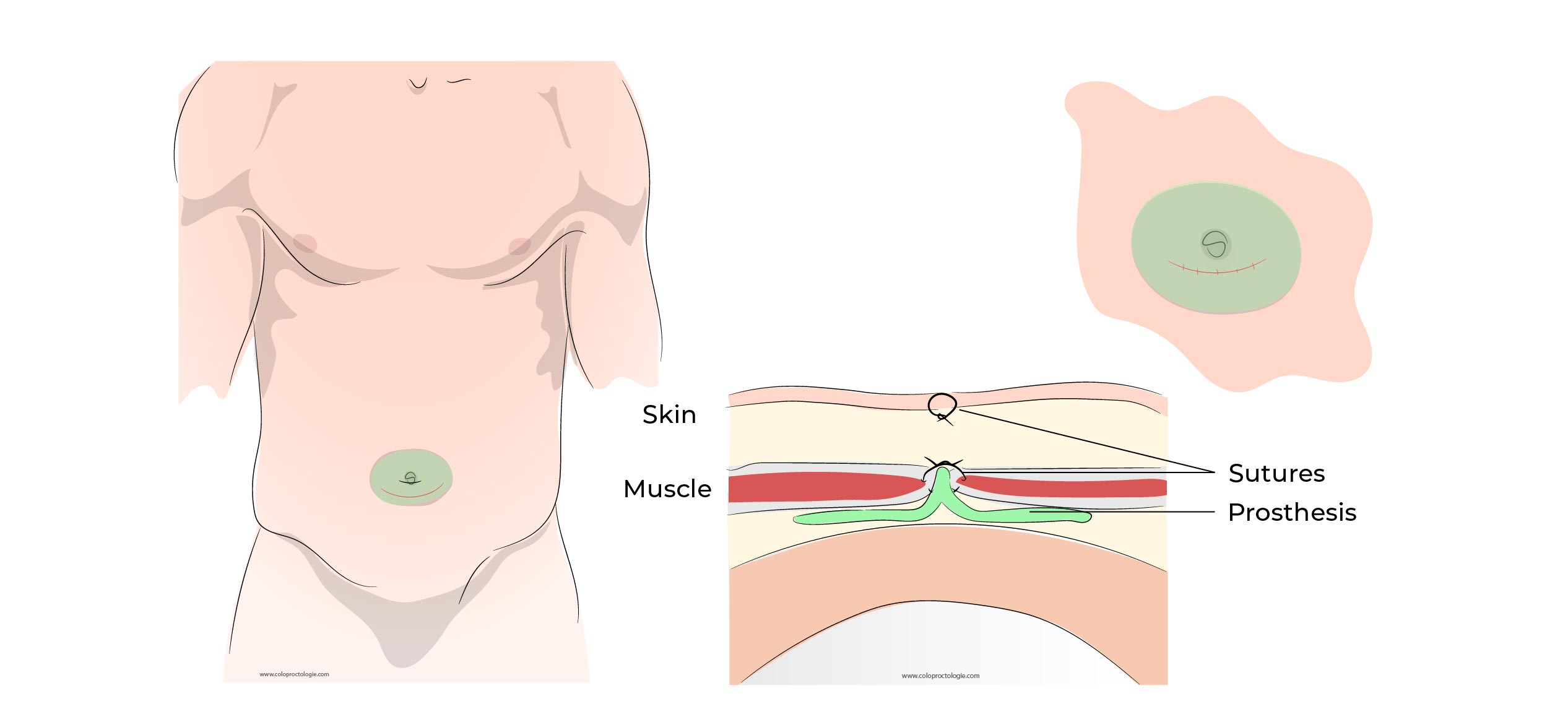 https://coloproctologie.com/wp-content/uploads/2023/01/Hernie-Ombilicale-Illustrations-37.jpg