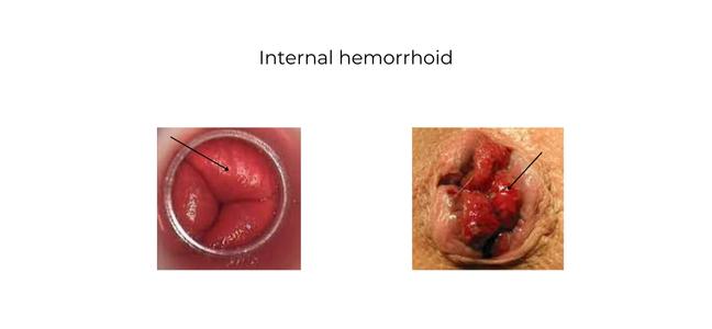 internal vs external hemorrhoids