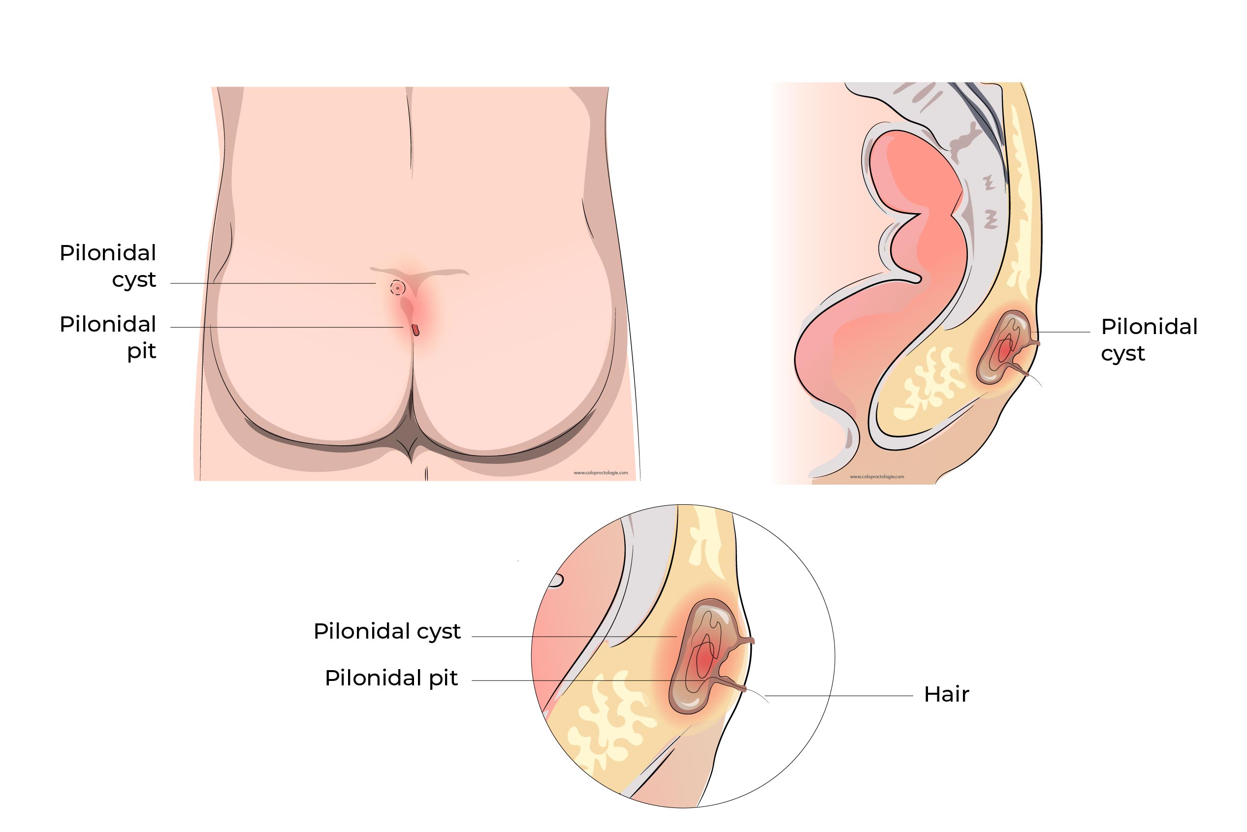 Pilonidal cyst Coloproctologie