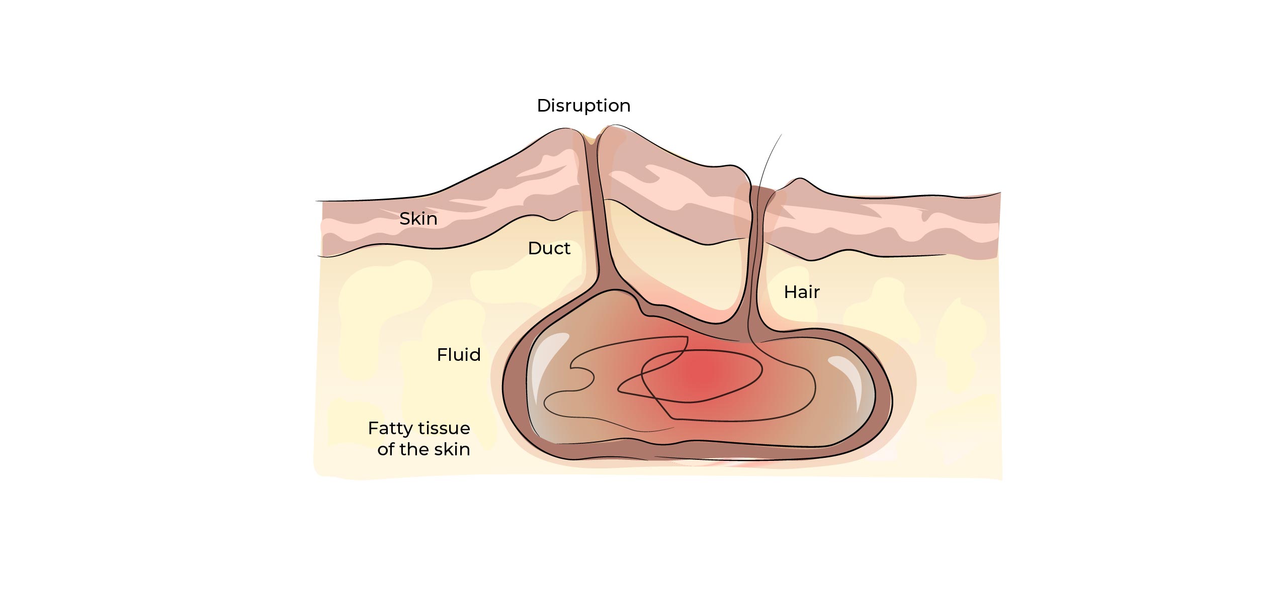 https://coloproctologie.com/wp-content/uploads/2023/01/Kyste-Pilonidale-Illustrations-22.jpg