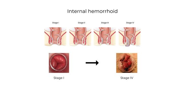 https://coloproctologie.com/wp-content/uploads/2023/01/hemorroide-Interne-Stage-I-Stage-IV.jpg