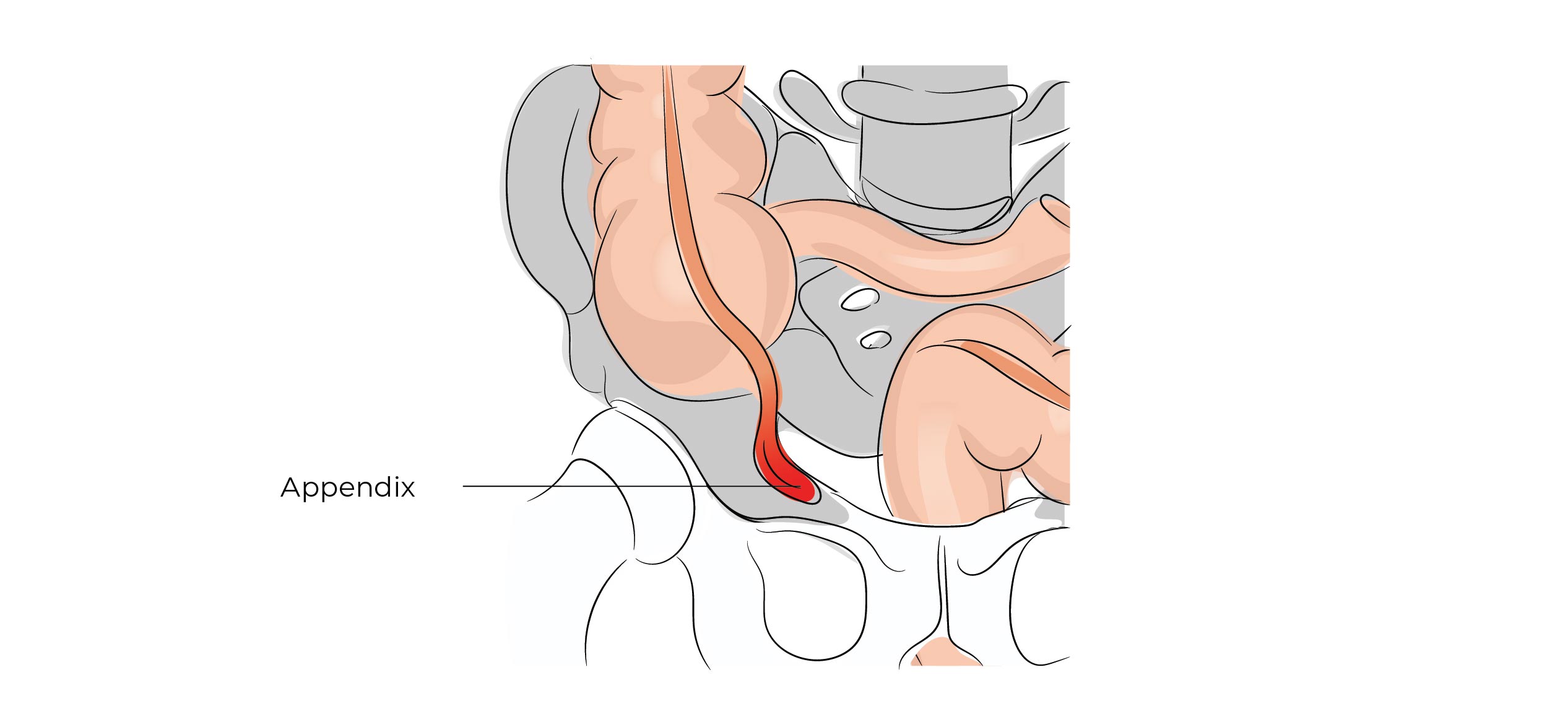 https://coloproctologie.com/wp-content/uploads/2023/02/Appendicectomie-13.jpg