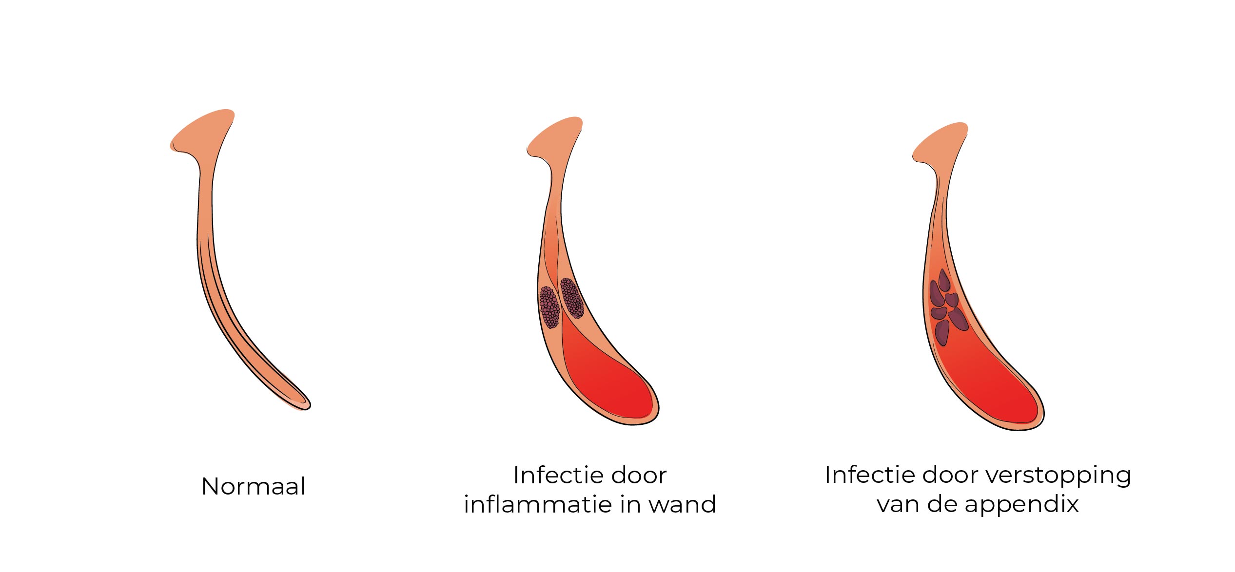 https://coloproctologie.com/wp-content/uploads/2023/02/Appendicectomie_Artboard-24-English-version-14.jpg