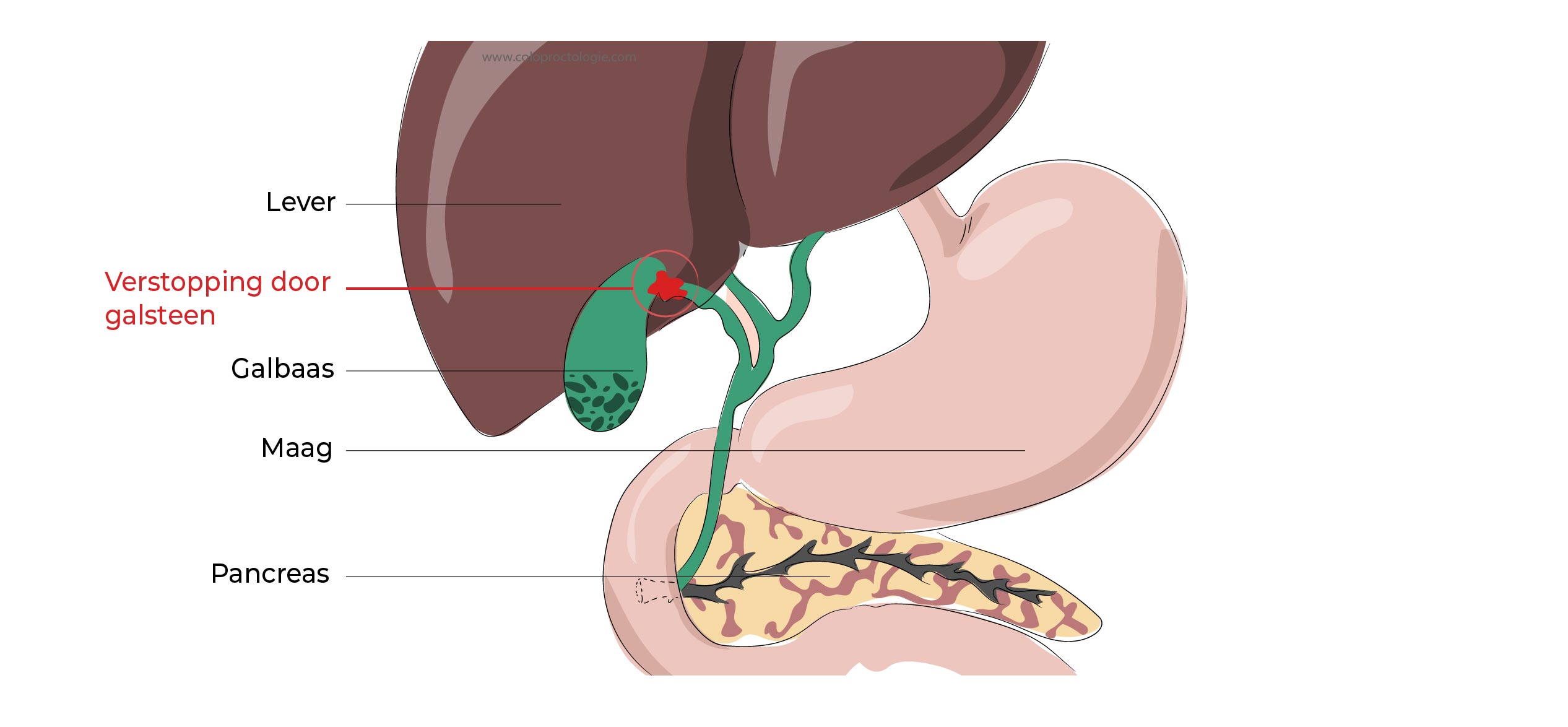 https://coloproctologie.com/wp-content/uploads/2023/02/Calculs-de-la-vesicule-biliaire-1-34.jpg