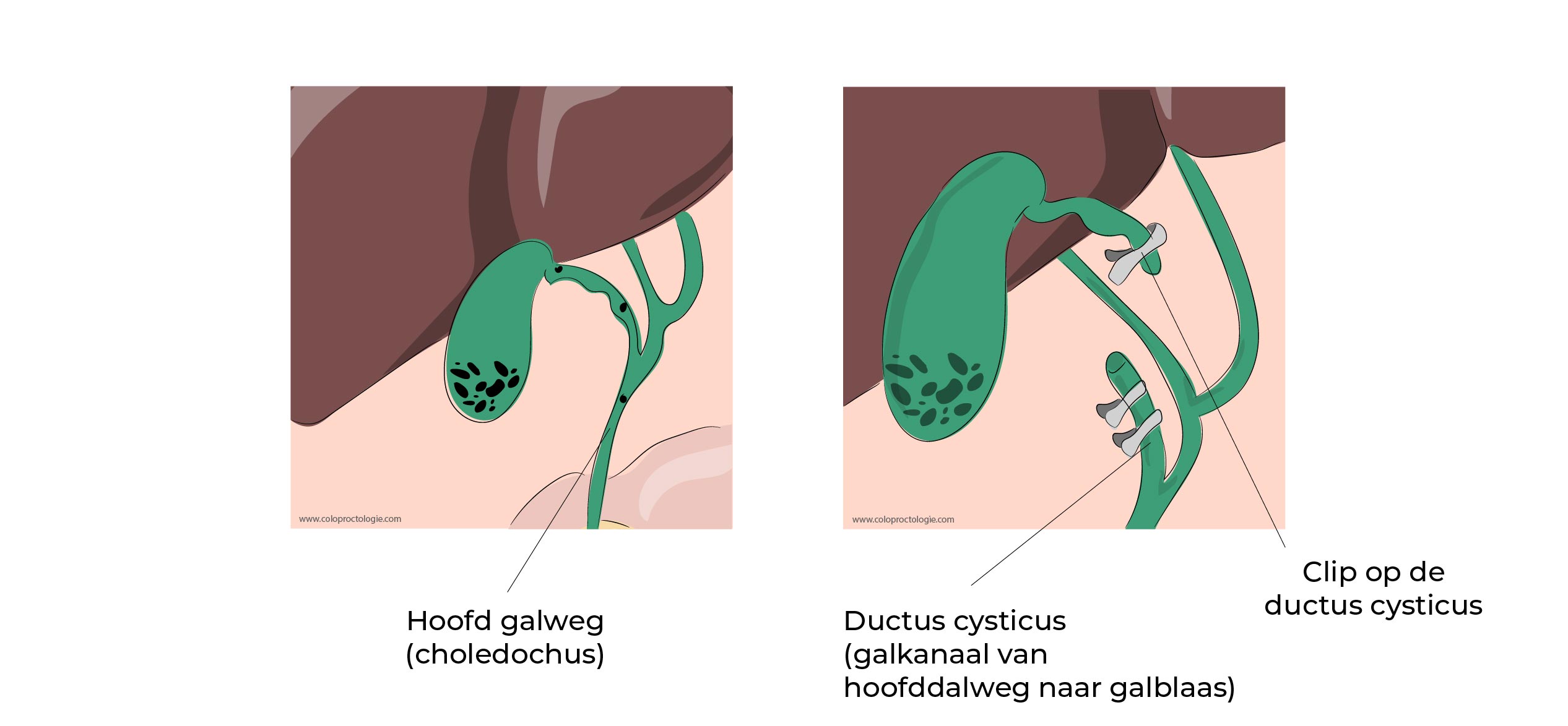 https://coloproctologie.com/wp-content/uploads/2023/02/Calculs-de-la-vesicule-biliaire-1-37.jpg