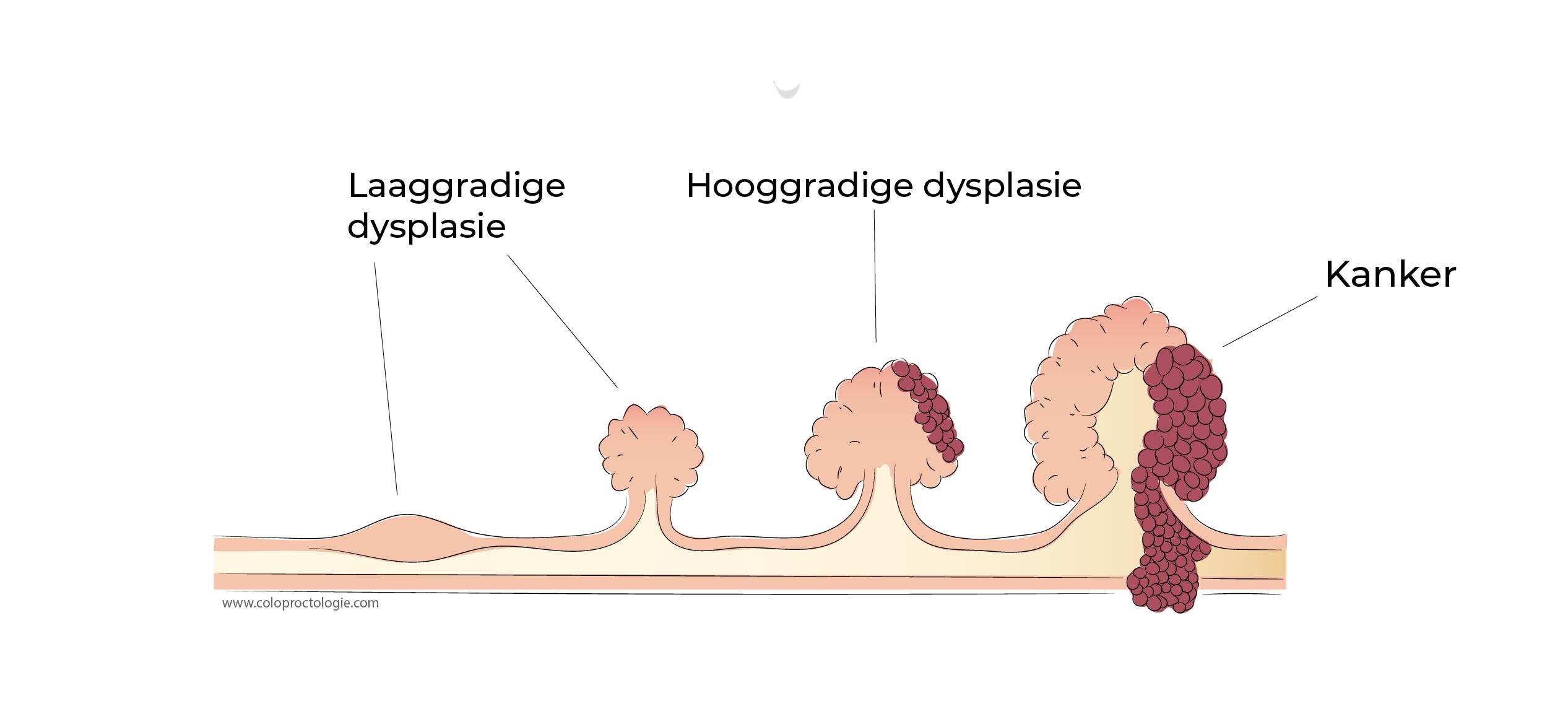 https://coloproctologie.com/wp-content/uploads/2023/02/Cancer-colorectal-09.jpg