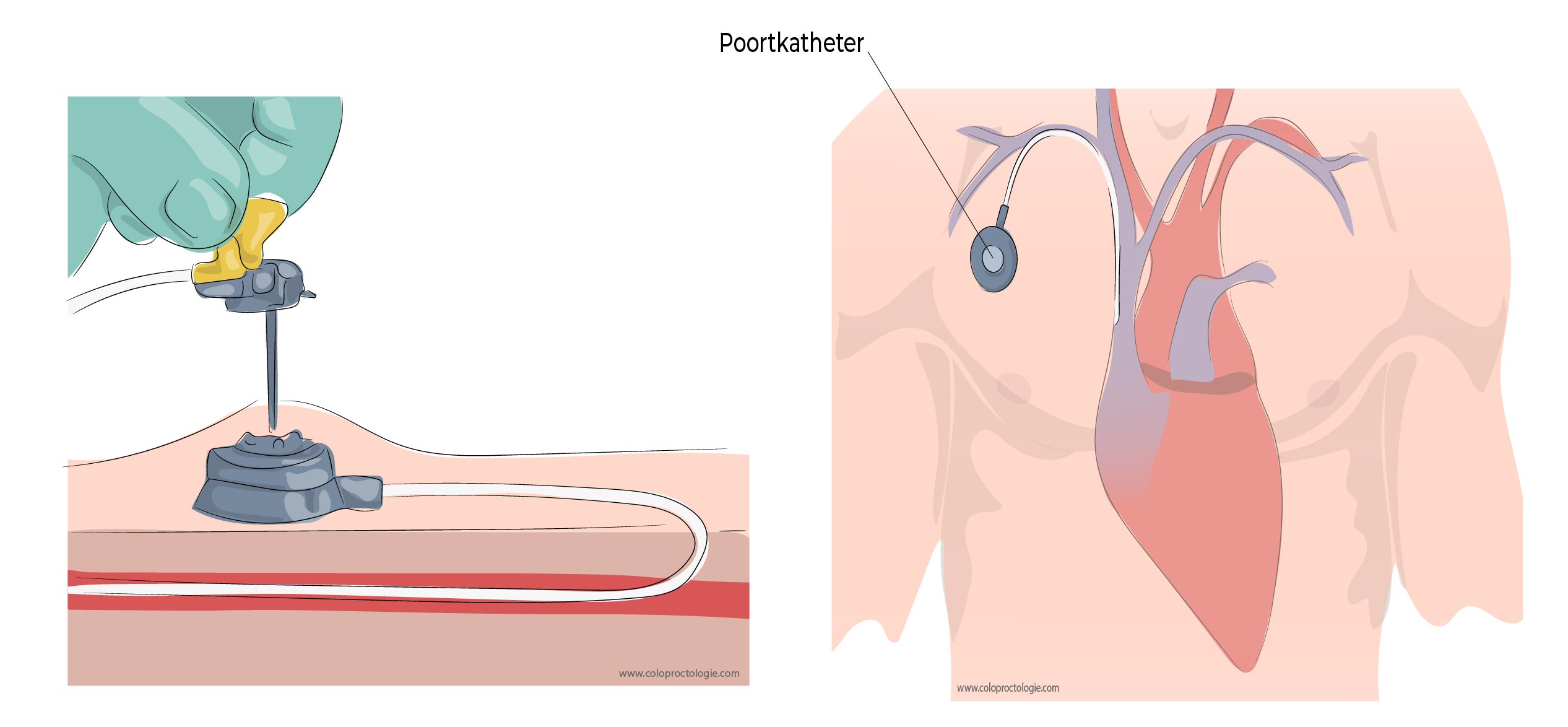 https://coloproctologie.com/wp-content/uploads/2023/02/Cancer-colorectal-11.jpg