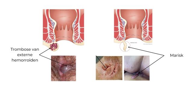 https://coloproctologie.com/wp-content/uploads/2023/02/Hemorroide-externe-ndls-1.jpg