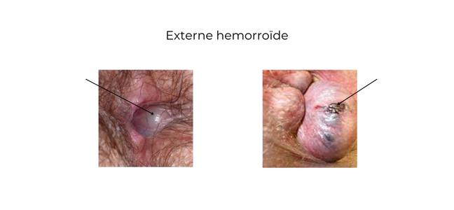 https://coloproctologie.com/wp-content/uploads/2023/02/Hemorroide-externe-ndls.jpg