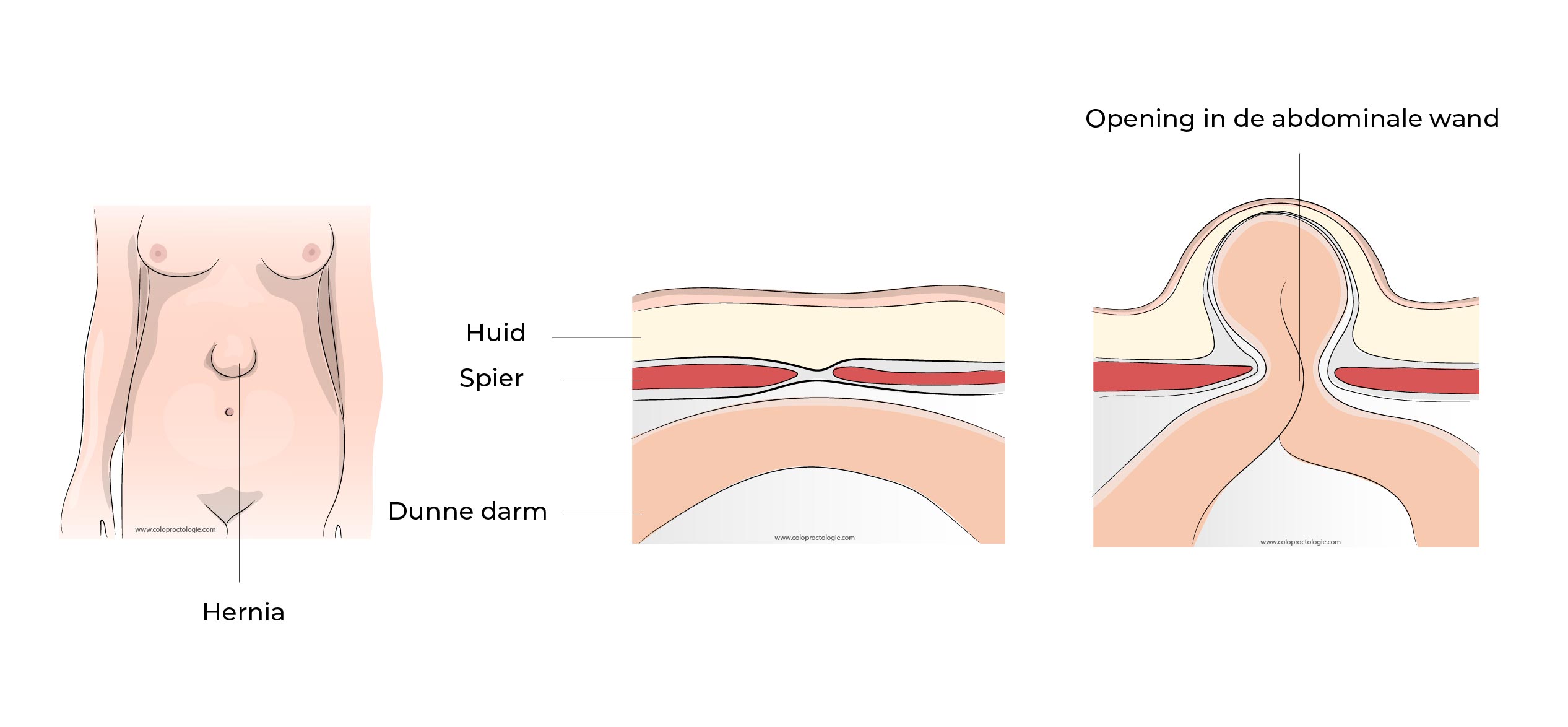 https://coloproctologie.com/wp-content/uploads/2023/02/Hernie-Ombilicale-Illustrations-38.jpg