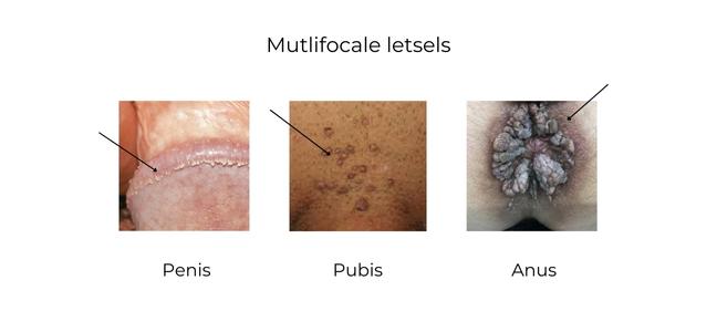 https://coloproctologie.com/wp-content/uploads/2023/02/lesions-ndls.jpg