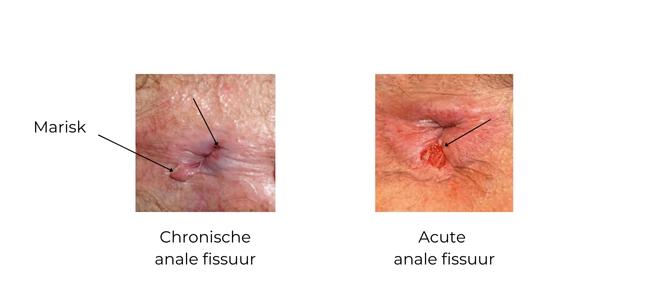 https://coloproctologie.com/wp-content/uploads/2023/02/skin-tags-and-anal-fissure-ndls-1.jpg