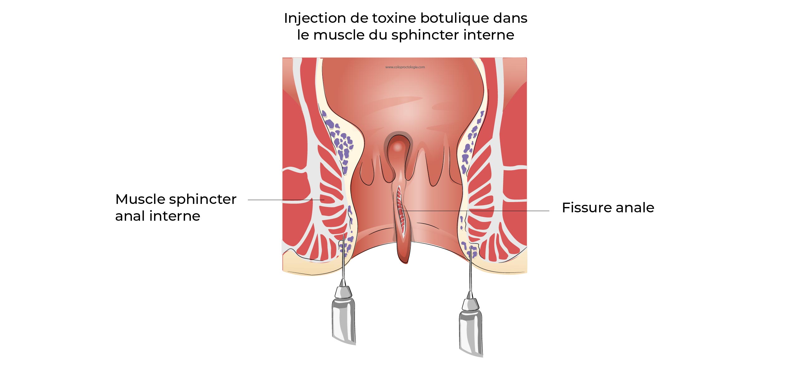 https://coloproctologie.com/wp-content/uploads/2023/03/Fissure-Anale_-11.jpg