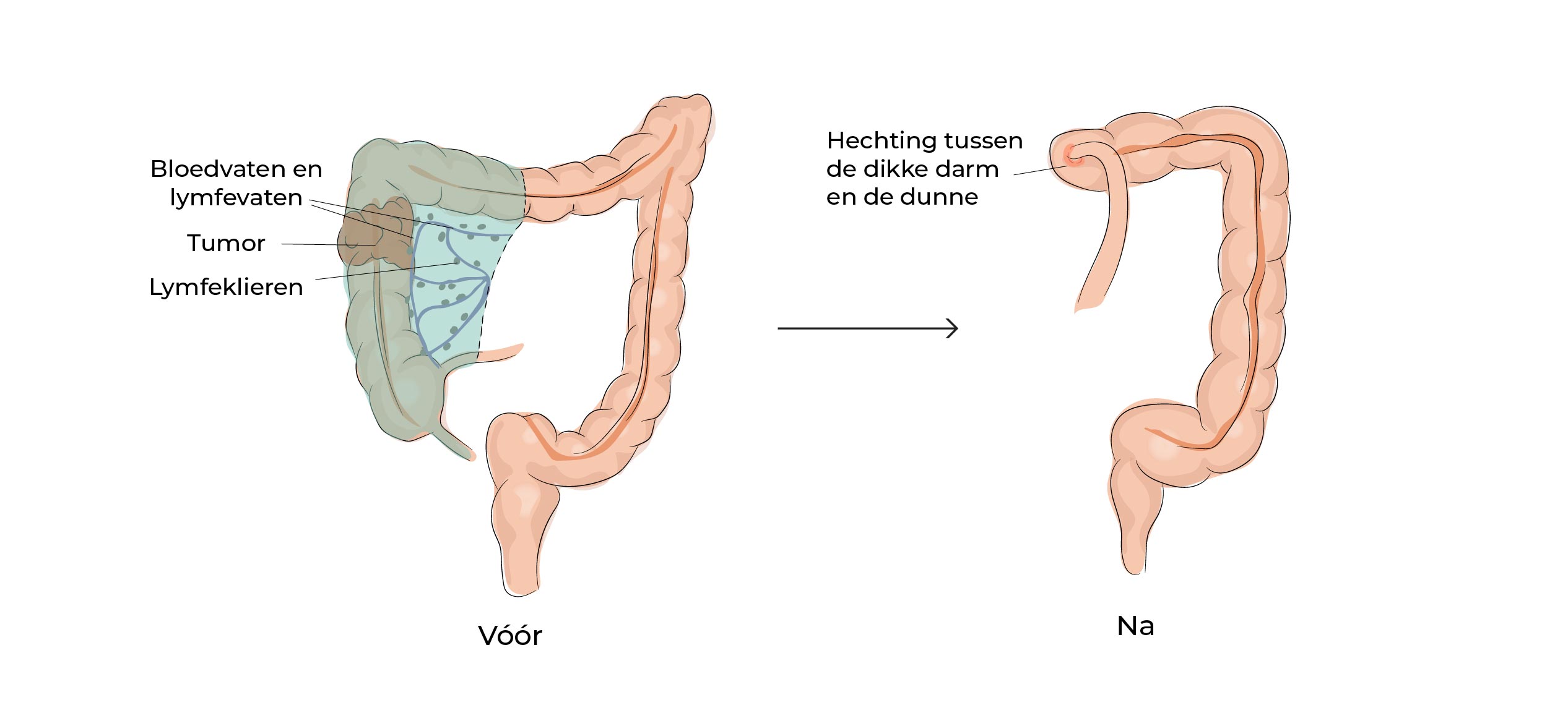 https://coloproctologie.com/wp-content/uploads/2023/07/Colectomie-droite-18.jpg